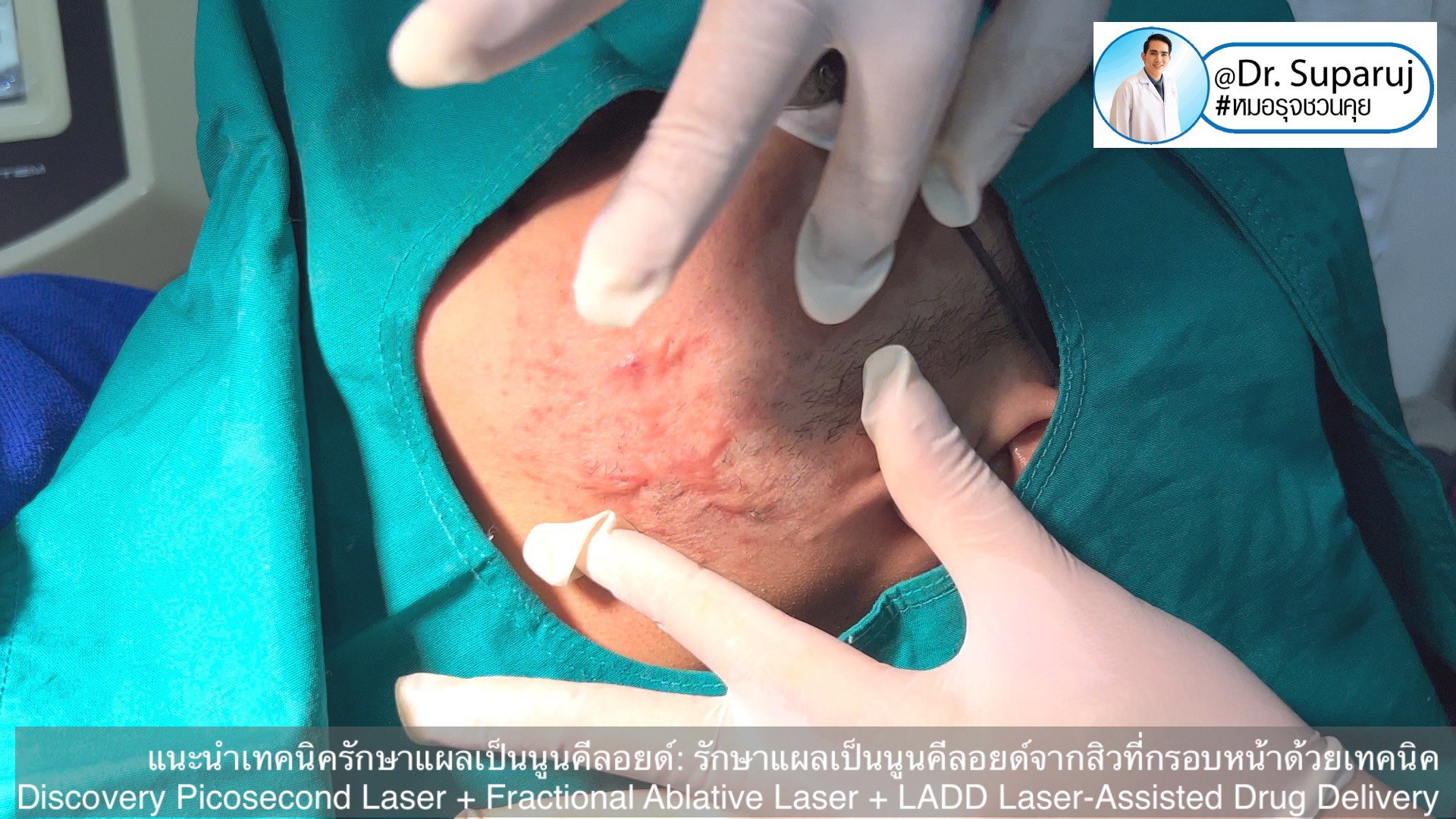 แนะนำเทคนิคดูแลแผลเป็นนูนคีลอยด์: รักษาแผลเป็นนูนคีลอยด์จากสิวที่กรอบหน้าด้วยเทคนิค Discovery Picosecond Laser + Fractional Ablative Laser + LADD Laser-Assisted Drug Delivery แนะนำเทคนิคดูแลแผลเป็นนูนคีลอยด์: รักษาแผลเป็นนูนคีลอยด์จากสิวที่กรอบหน้าด้วยเทคนิค Discovery Picosecond Laser + Fractional Ablative Laser + LADD Laser-Assisted Drug Delivery