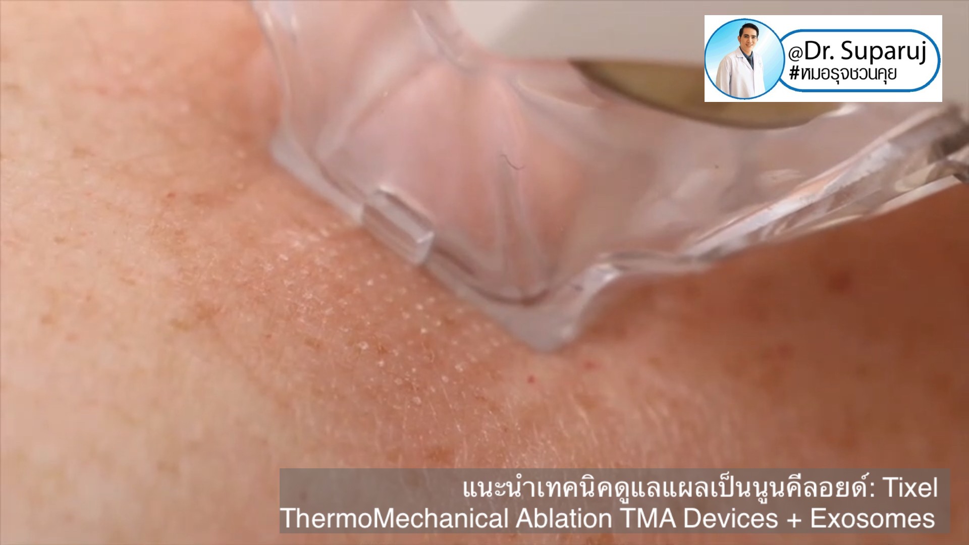 แนะนำเทคนิคดูแลแผลเป็นนูนคีลอยด์: รักษาแผลเป็นนูนด้วยทิกเซลล์ Tixel Fractional ThermoMechanical Ablation Devices + Exosomes แนะนำเทคนิคดูแลแผลเป็นนูนคีลอยด์: รักษาแผลเป็นนูนด้วยทิกเซลล์ Tixel Fractional ThermoMechanical Ablation Devices + Exosomes
