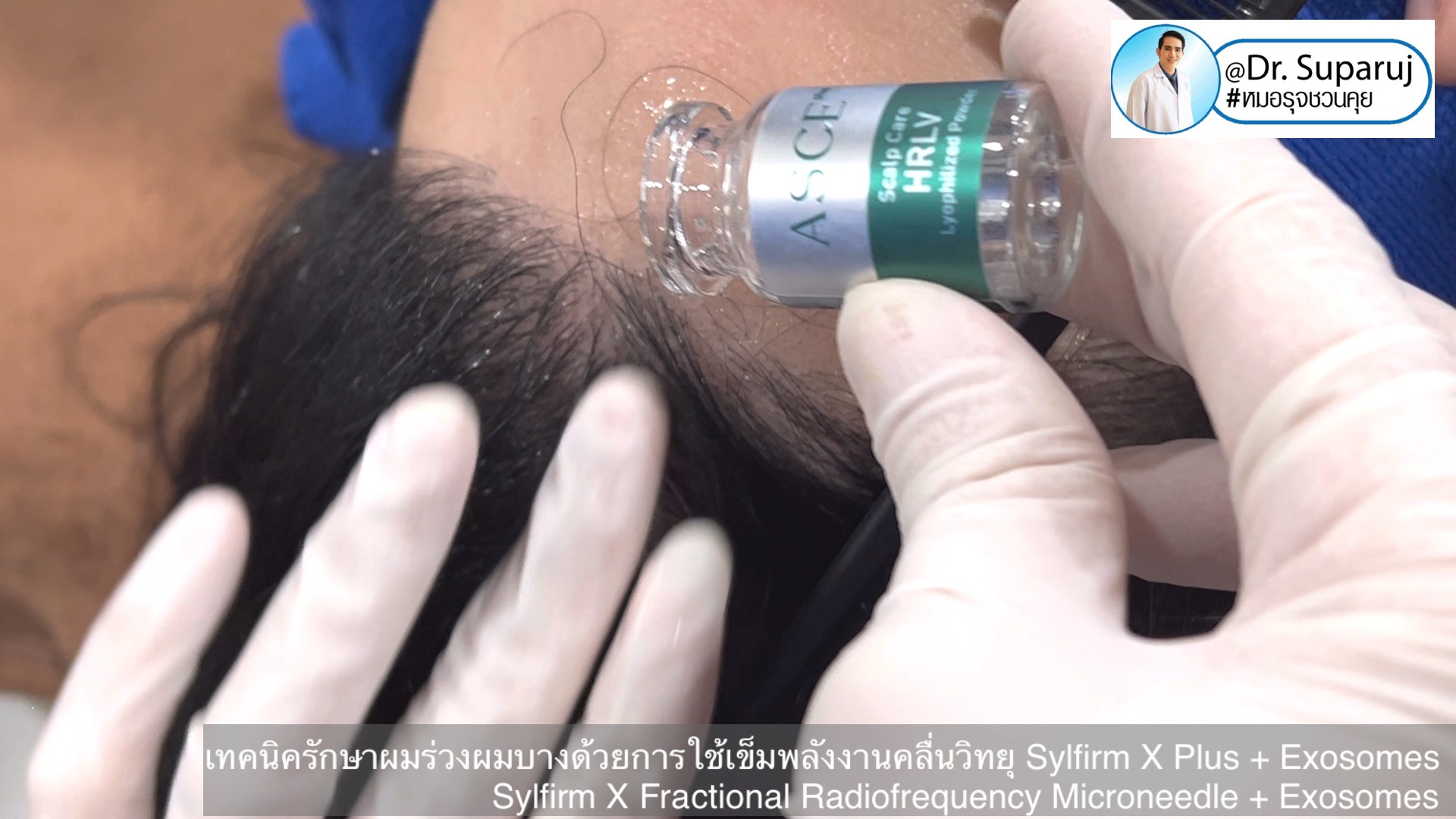 แนะนำ เทคนิครักษาผมร่วงผมบางด้วยการใช้เข็มพลังงานคลื่นวิทยุ Sylfirm X Plus + Exosomes (Sylfirm X Fractional Radiofrequency Microneedle + Exosomes) แนะนำ เทคนิครักษาผมร่วงผมบางด้วยการใช้เข็มพลังงานคลื่นวิทยุ Sylfirm X Plus + Exosomes (Sylfirm X Fractional Radiofrequency Microneedle + Exosomes)