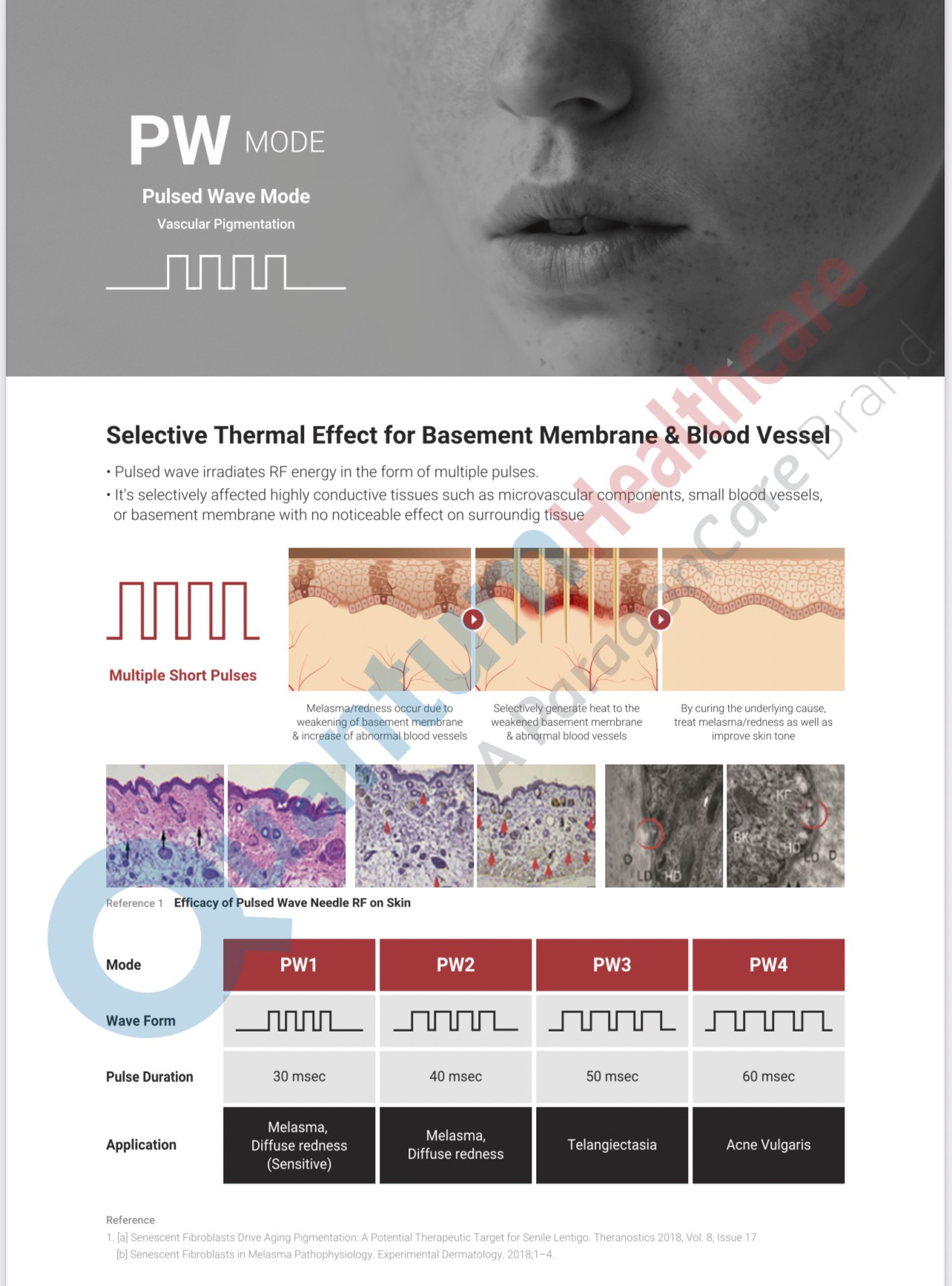 Update เทคนิคยกกระชับผิว หลุมสิว ดูแลปัญหาเม็ดสี ฝ้า+เส้นเลือด: SYLFIRM X นวัตกรรมคลื่นวิทยุแบบเข็ม (Fractional microneedle Radiofrequency) Update เทคนิคยกกระชับผิว หลุมสิว ดูแลปัญหาเม็ดสี ฝ้า+เส้นเลือด: SYLFIRM X นวัตกรรมคลื่นวิทยุแบบเข็ม (Fractional microneedle Radiofrequency)