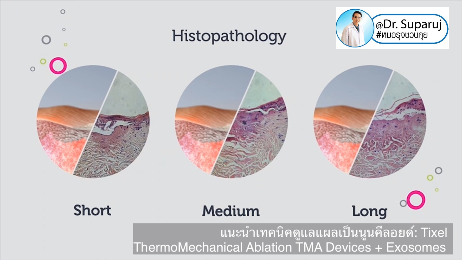แนะนำเทคนิคดูแลแผลเป็นนูนคีลอยด์: รักษาแผลเป็นนูนด้วยทิกเซลล์ Tixel Fractional ThermoMechanical Ablation Devices + Exosomes แนะนำเทคนิคดูแลแผลเป็นนูนคีลอยด์: รักษาแผลเป็นนูนด้วยทิกเซลล์ Tixel Fractional ThermoMechanical Ablation Devices + Exosomes