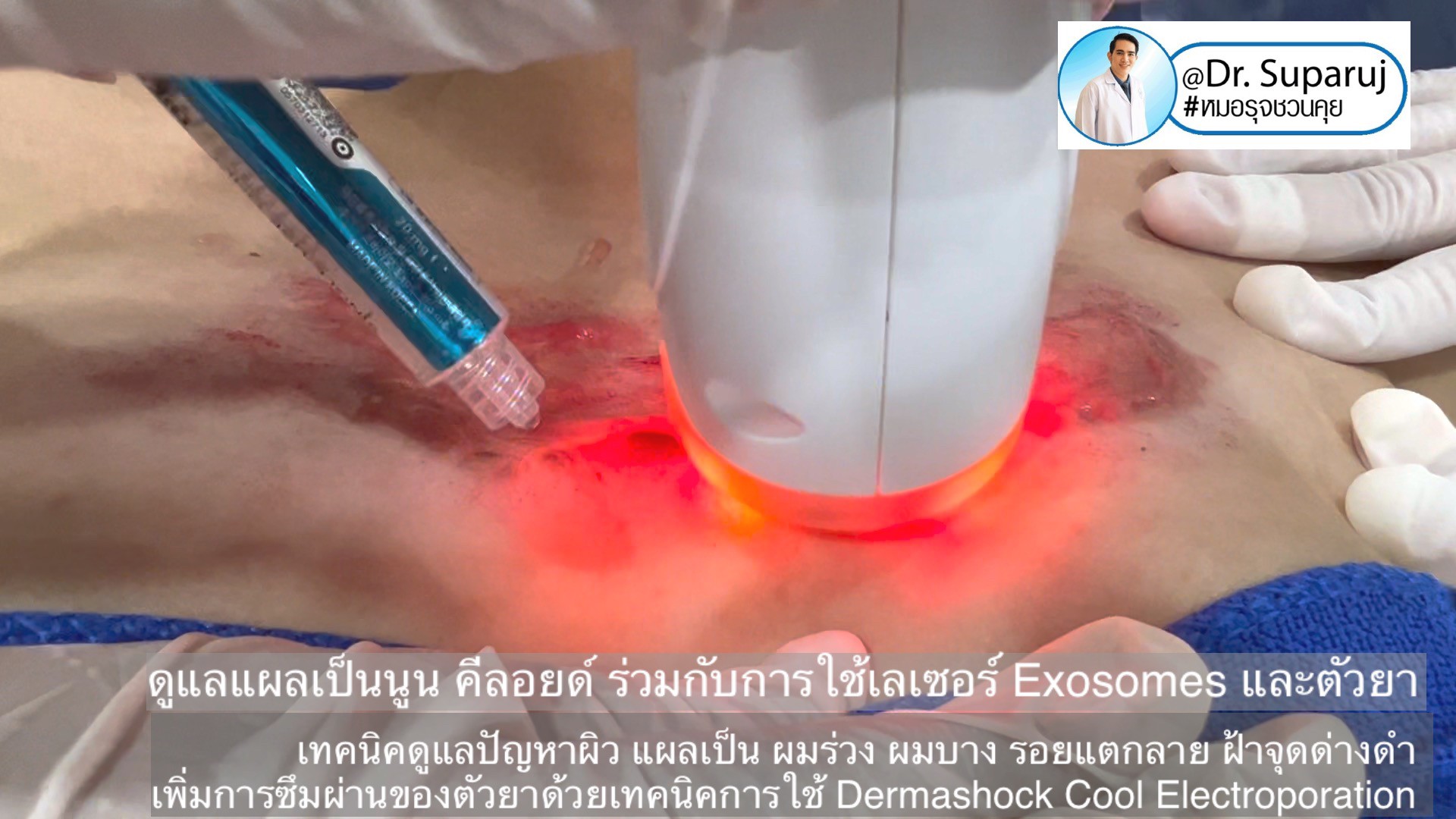 เทคนิคดูแลปัญหาผิว แผลเป็น ผมร่วง ผมบาง รอยแตกลาย ฝ้าจุดด่างดำ เพิ่มการซึมผ่านของตัวยาด้วยเทคนิคการใช้ Dermashock Cool Electroporation เทคนิคดูแลปัญหาผิว แผลเป็น ผมร่วง ผมบาง รอยแตกลาย ฝ้าจุดด่างดำ เพิ่มการซึมผ่านของตัวยาด้วยเทคนิคการใช้ Dermashock Cool Electroporation