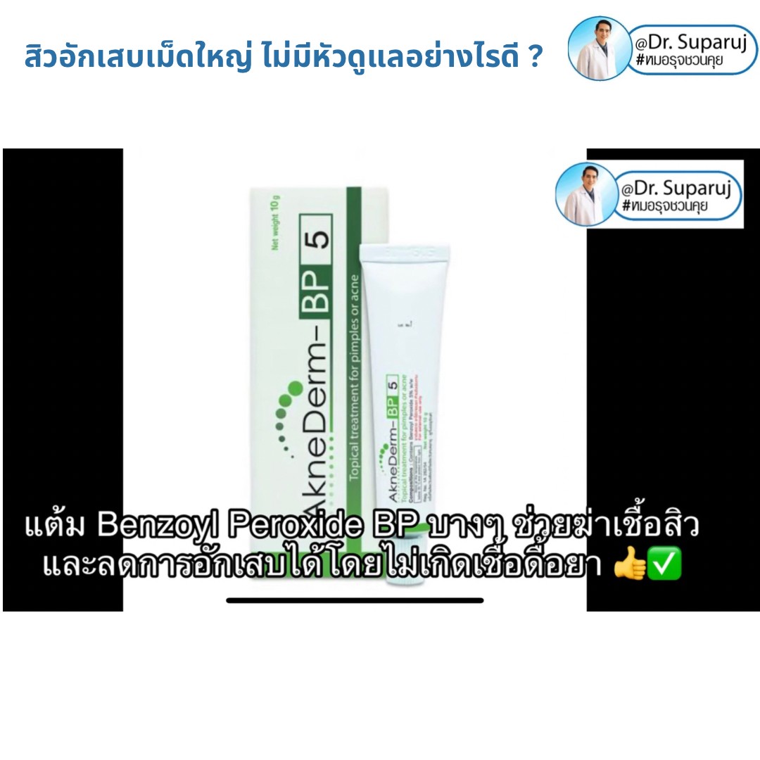 มีสิวอักเสบเม็ดใหญ่ ไม่มีหัว ขึ้น ดูแลอย่างไรดี ? มีสิวอักเสบเม็ดใหญ่ ไม่มีหัว ขึ้น ดูแลอย่างไรดี ?