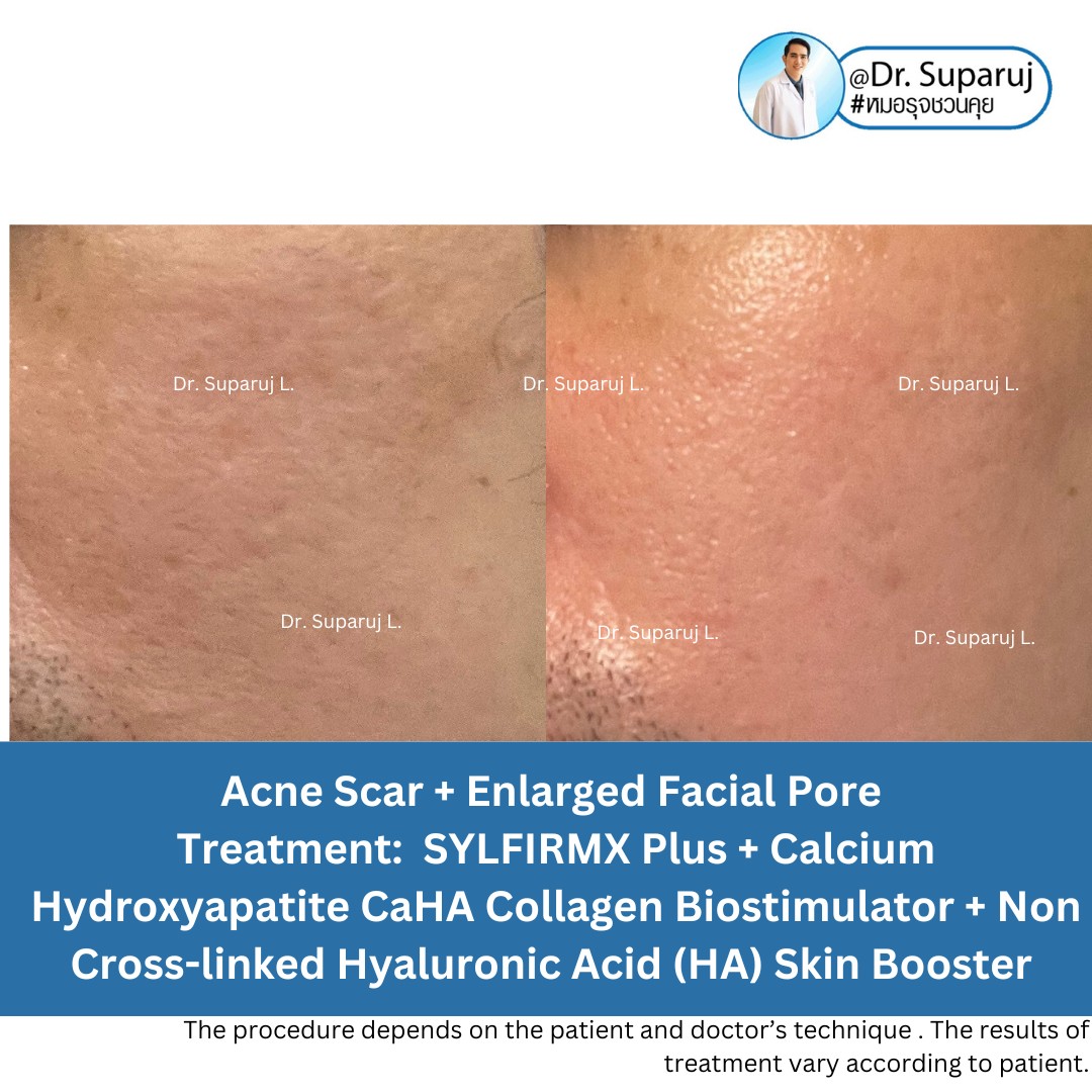 ผลลัพธ์อาจแตกต่างกันไป แล้วแต่บุคคล  ผลลัพธ์อาจแตกต่างกันไป แล้วแต่บุคคล