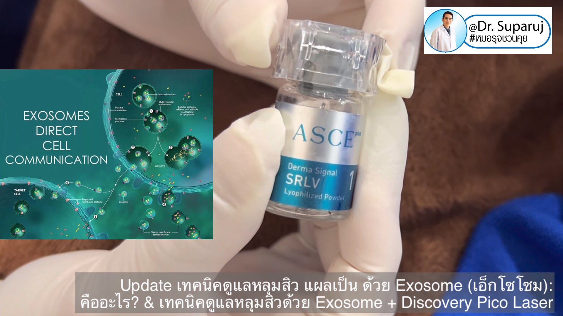 แนะนำเทคนิคในการดูแลหลุมสิว: Exosome ใน การรักษาหลุมสิว (Exosome & acne scar treatment)