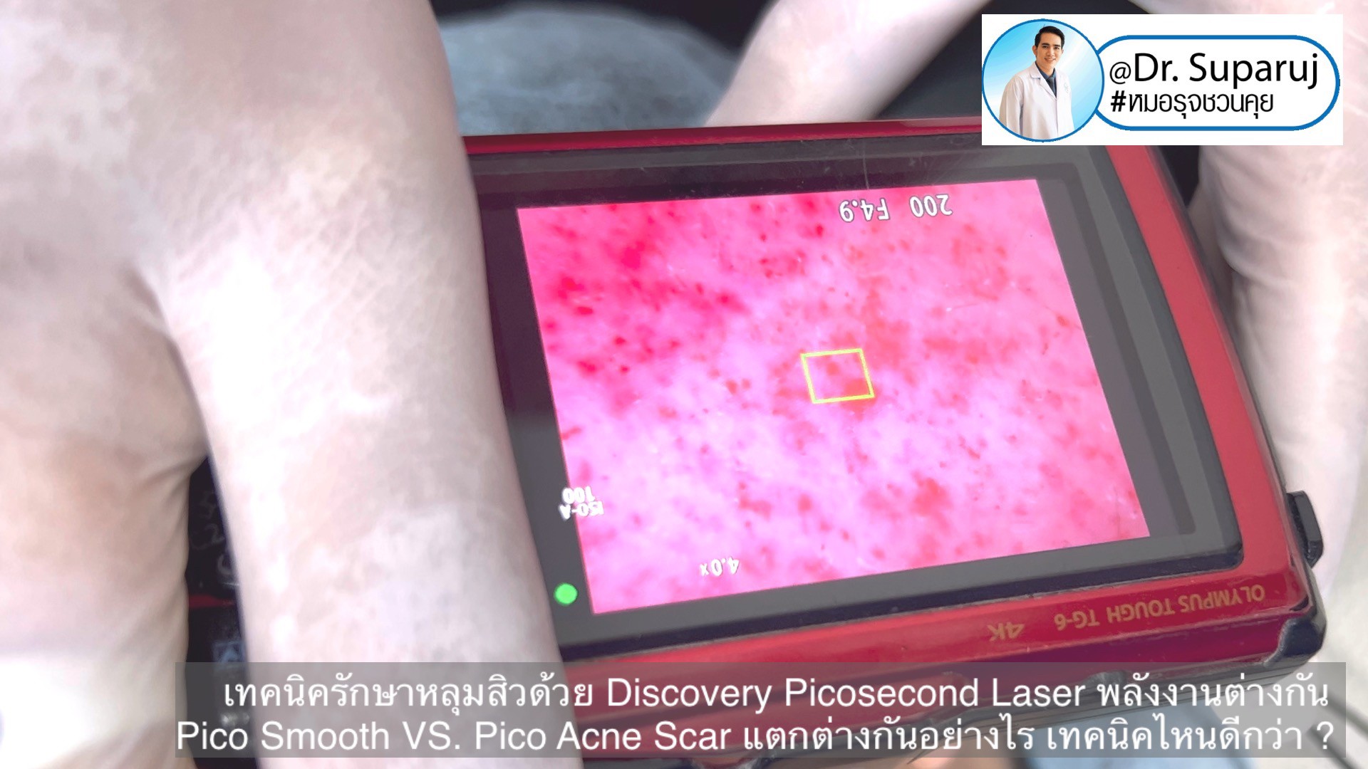 Q:Picosecond Laser หลุมสิวต้องยิงให้เลือดสาดไหม?