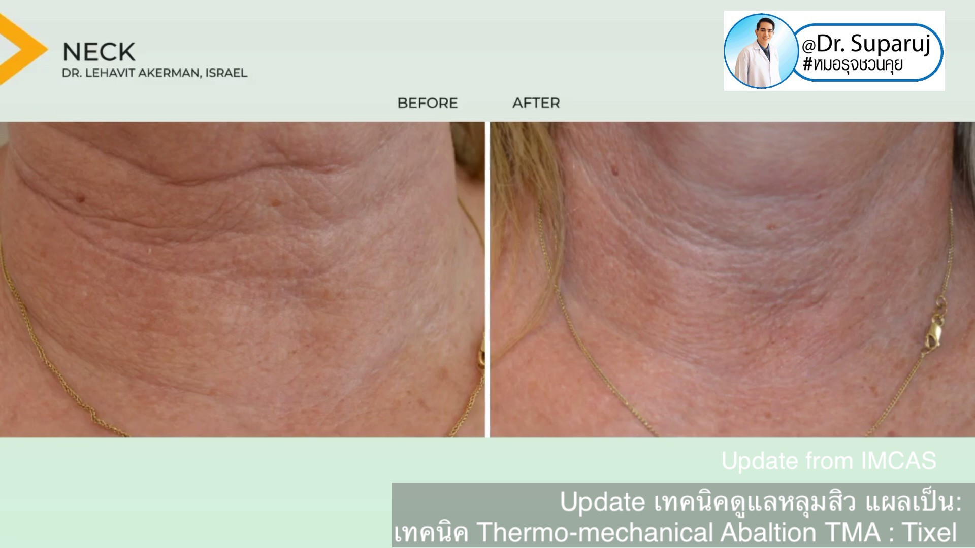 Update from IMCAS เทคนิครักษาหลุมสิว แผลเป็น ริ้วรอย: Tixel เทคนิค Thermo-mechanical Abaltion TMA Update from IMCAS เทคนิครักษาหลุมสิว แผลเป็น ริ้วรอย: Tixel เทคนิค Thermo-mechanical Abaltion TMA