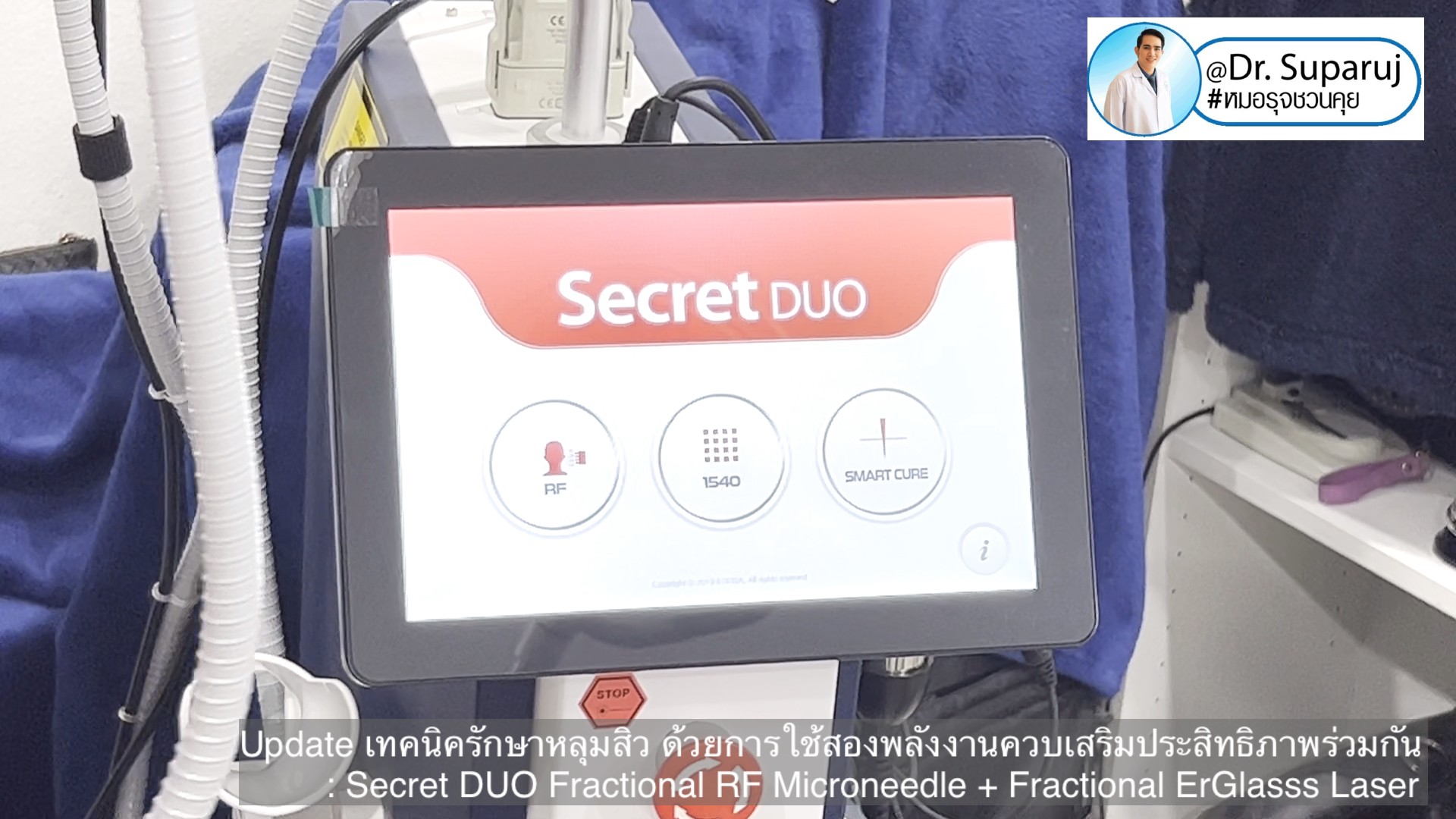 Update เทคนิครักษาหลุมสิว ด้วยการใช้สองพลังงานเสริมประสิทธิภาพร่วมกัน: Secret DUO Fractional RF Microneedle + Fractional ErGlasss Laser