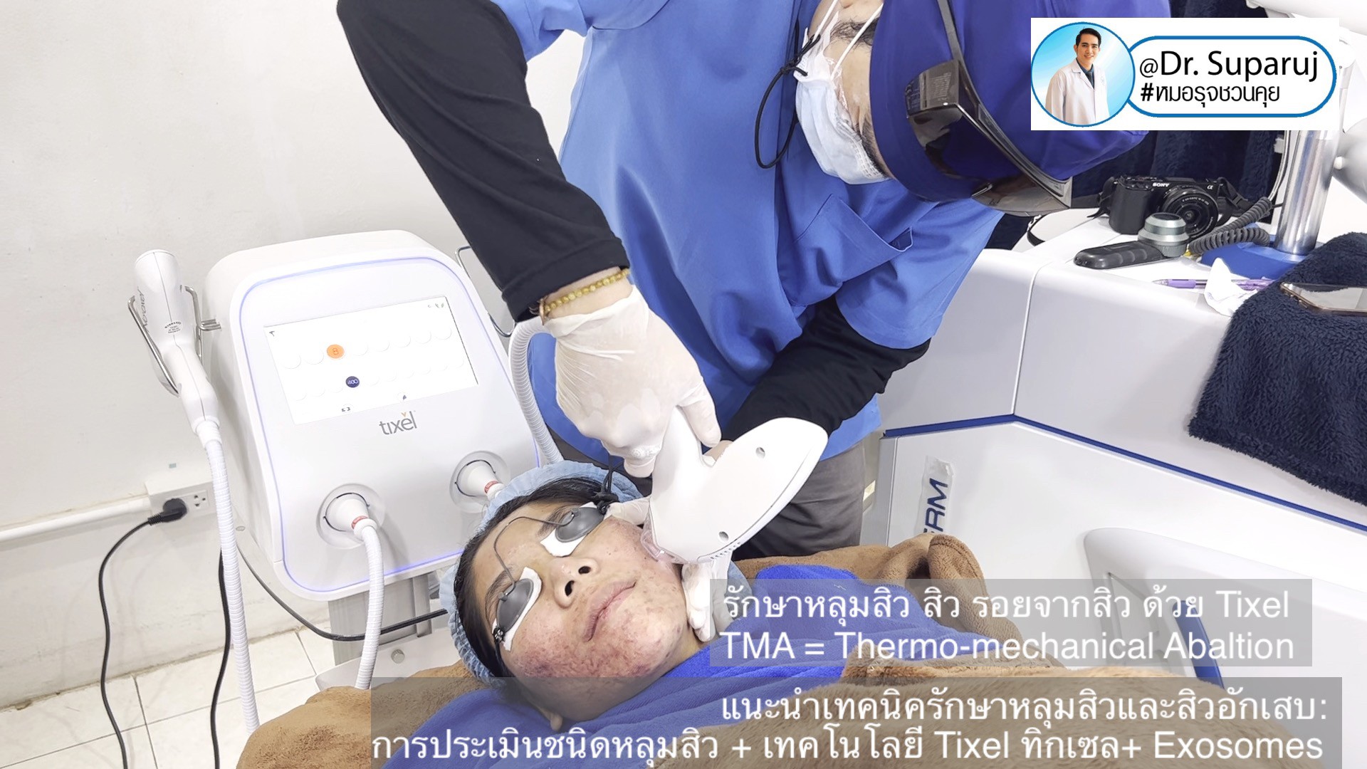 แนะนำเทคนิครักษาหลุมสิวและสิวอักเสบ: ประเมินชนิดความรุนแรงหลุมสิว + เทคโนโลยี Tixel ทิกเซล+ Exosomes แนะนำเทคนิครักษาหลุมสิวและสิวอักเสบ: ประเมินชนิดความรุนแรงหลุมสิว + เทคโนโลยี Tixel ทิกเซล+ Exosomes