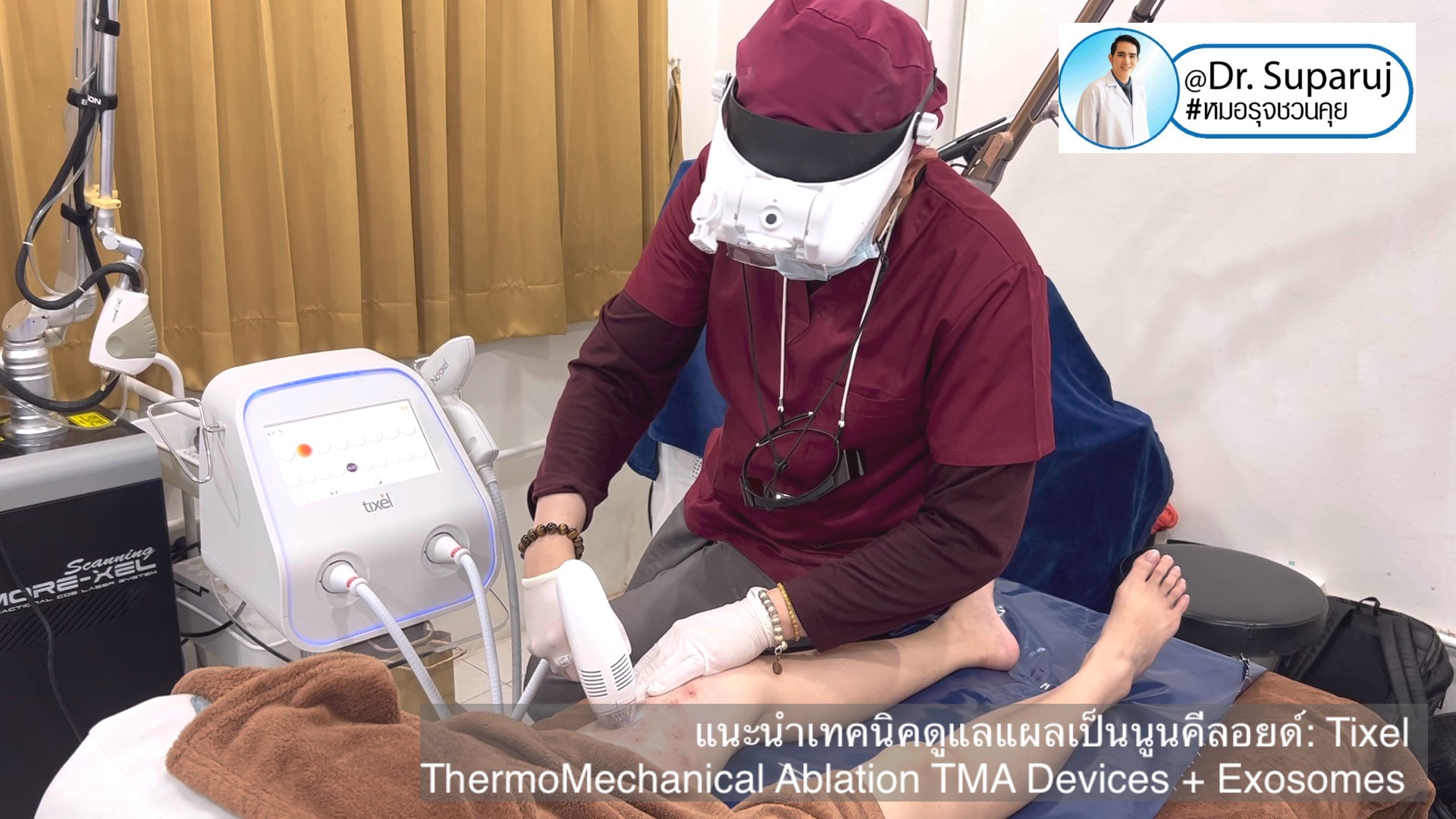 แนะนำเทคนิคดูแลแผลเป็นนูนคีลอยด์: รักษาแผลเป็นนูนด้วยทิกเซลล์ Tixel Fractional ThermoMechanical Ablation Devices + Exosomes แนะนำเทคนิคดูแลแผลเป็นนูนคีลอยด์: รักษาแผลเป็นนูนด้วยทิกเซลล์ Tixel Fractional ThermoMechanical Ablation Devices + Exosomes