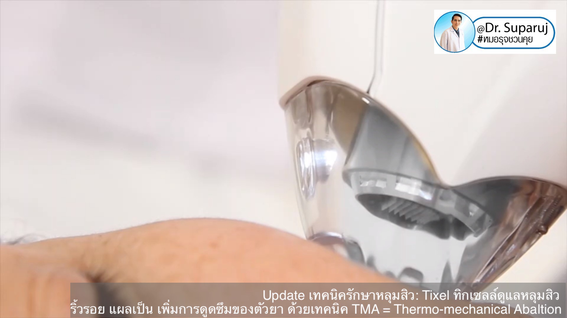 Update เทคนิครักษาหลุมสิว: Tixel ทิ๊กเซลล์ รักษาหลุมสิว ริ้วรอย แผลเป็น เพิ่มการดูดซึมยาด้วยเทคนิค TMA = Thermo-mechanical Abaltion Update เทคนิครักษาหลุมสิว: Tixel ทิ๊กเซลล์ รักษาหลุมสิว ริ้วรอย แผลเป็น เพิ่มการดูดซึมยาด้วยเทคนิค TMA = Thermo-mechanical Abaltion