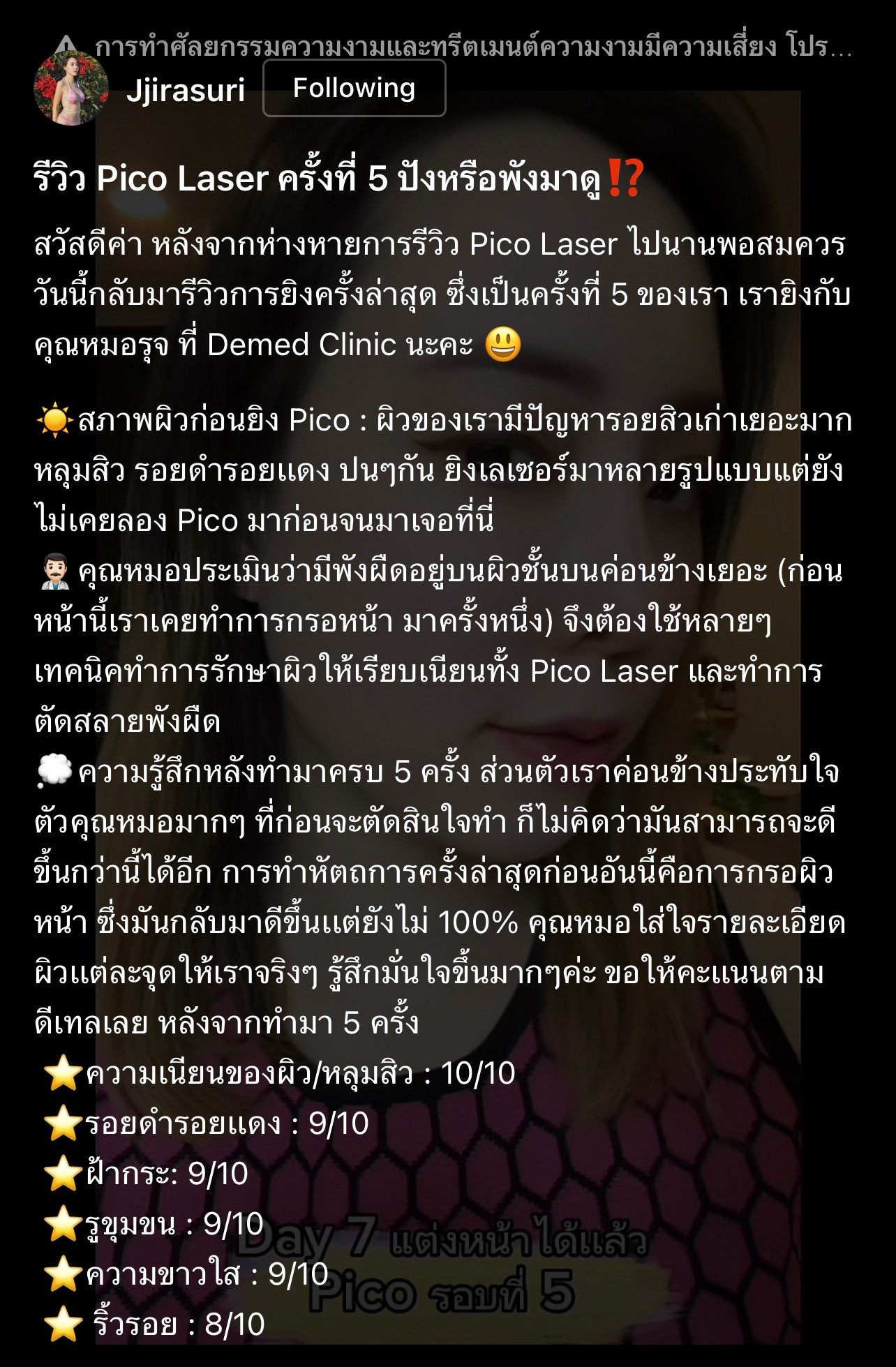 รีวิว Pico Laser รักษาหลุมสิวครั้งที่ 5 ปังหรือพังมาดู !?