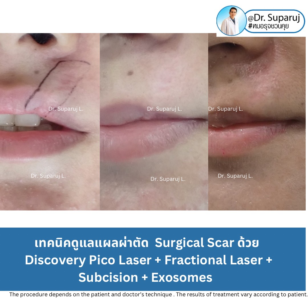 แนะนำเทคนิคดูแลแผลเป็นนูนคีลอยด์: รักษาแผลเป็นนูนด้วยทิกเซลล์ Tixel Fractional ThermoMechanical Ablation Devices + Exosomes แนะนำเทคนิคดูแลแผลเป็นนูนคีลอยด์: รักษาแผลเป็นนูนด้วยทิกเซลล์ Tixel Fractional ThermoMechanical Ablation Devices + Exosomes