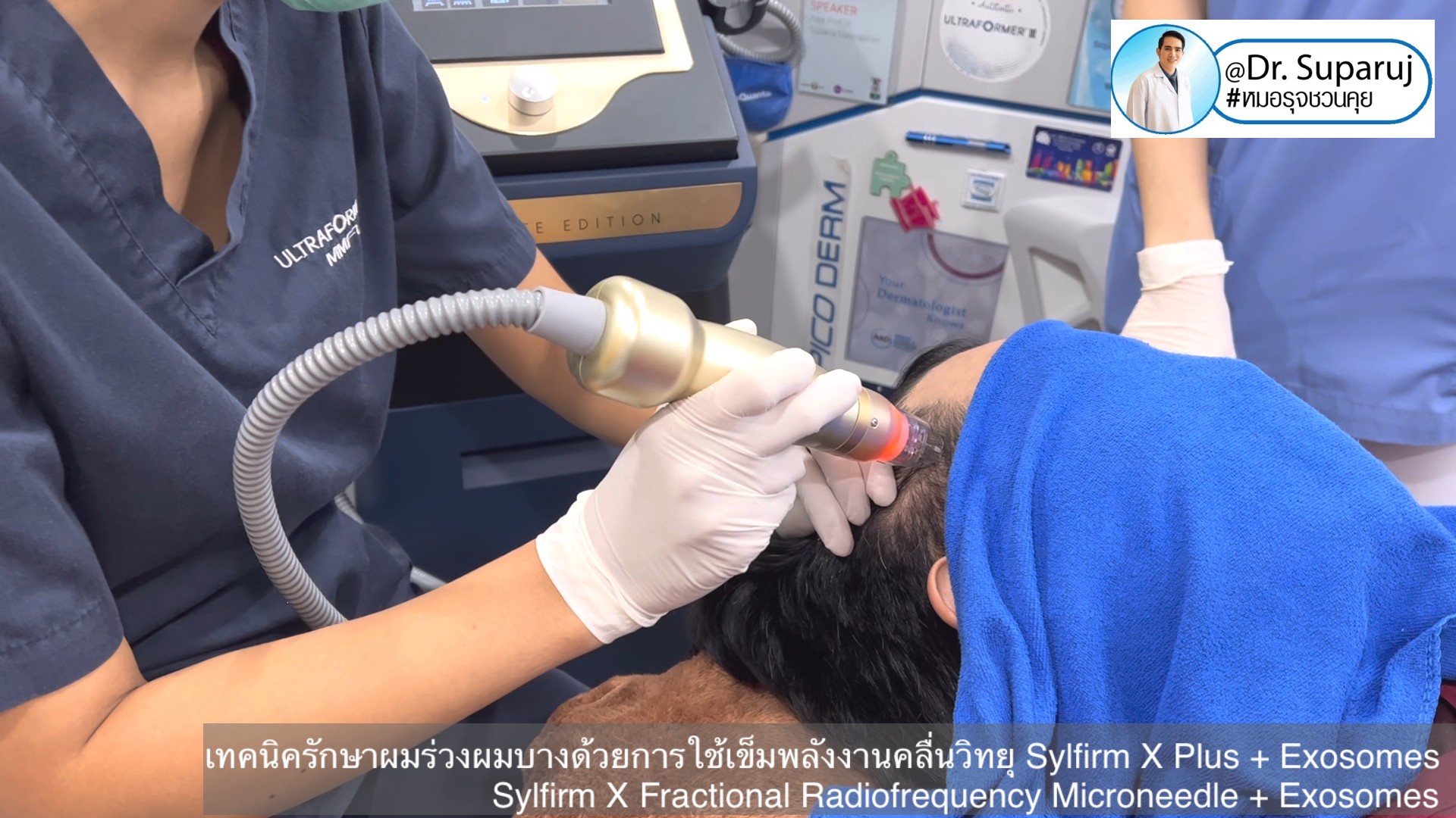 แนะนำเทคนิคดูแลผมร่วงผมบางด้วย Sylfirm X Fractional RF Microneedle + Exosomes for Hair Loss Treatment แนะนำเทคนิคดูแลผมร่วงผมบางด้วย Sylfirm X Fractional RF Microneedle + Exosomes for Hair Loss Treatment