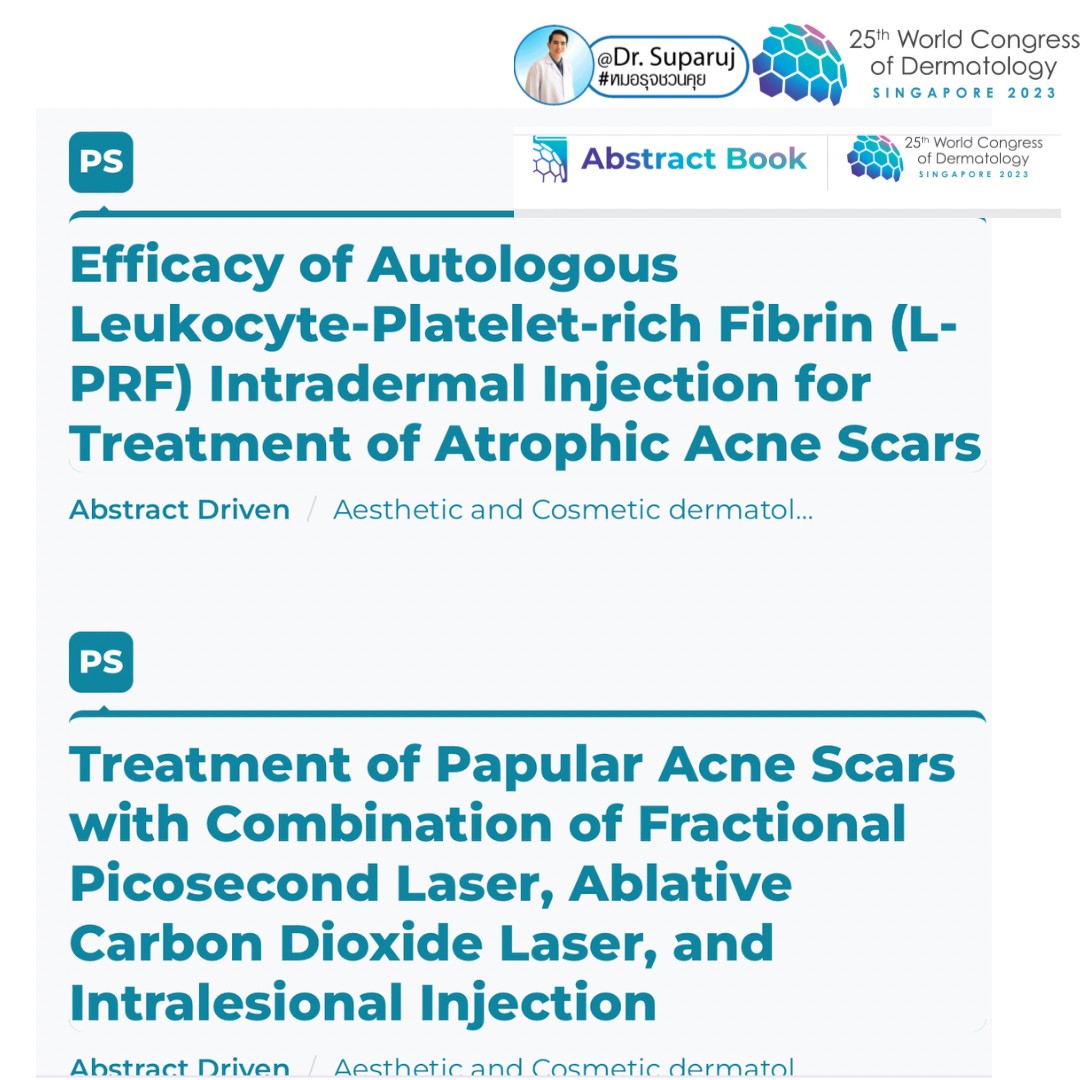 หมอรุจได้เข้าร่วมประชุม และนำเสนอผลงานวิจัยด้านการรักษาหลุมสิวแผลเป็นผมร่วงผมบาง ในงานประชุมแพทย์ผิวหนังระดับโลก World Congress of Dermatology WCD2023 ที่ประเทศสิงคโปร์ครับ หมอรุจได้เข้าร่วมประชุม และนำเสนอผลงานวิจัยด้านการรักษาหลุมสิวแผลเป็นผมร่วงผมบาง ในงานประชุมแพทย์ผิวหนังระดับโลก World Congress of Dermatology WCD2023 ที่ประเทศสิงคโปร์ครับ
