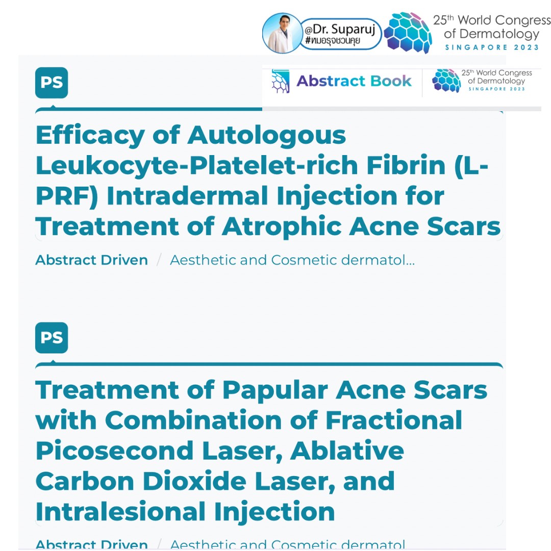 หมอรุจได้เข้าร่วมประชุม และนำเสนอผลงานวิจัยด้านการรักษาหลุมสิวแผลเป็นผมร่วงผมบาง ในงานประชุมแพทย์ผิวหนังระดับโลก World Congress of Dermatology WCD2023 ที่ประเทศสิงคโปร์ครับ
