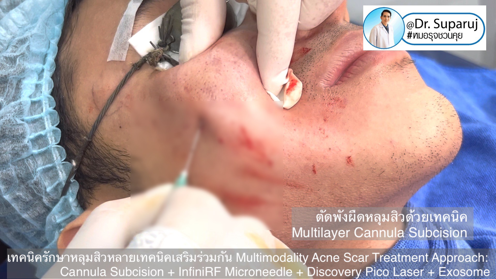 เทคนิครักษาหลุมสิวด้วยหลายเทคนิคเสริมร่วมกัน Multimodality Acne Scar Treatment Approach: Cannula Subcision + InfiniRF Microneedle + Discovery Pico Laser + Exosome เทคนิครักษาหลุมสิวด้วยหลายเทคนิคเสริมร่วมกัน Multimodality Acne Scar Treatment Approach: Cannula Subcision + InfiniRF Microneedle + Discovery Pico Laser + Exosome