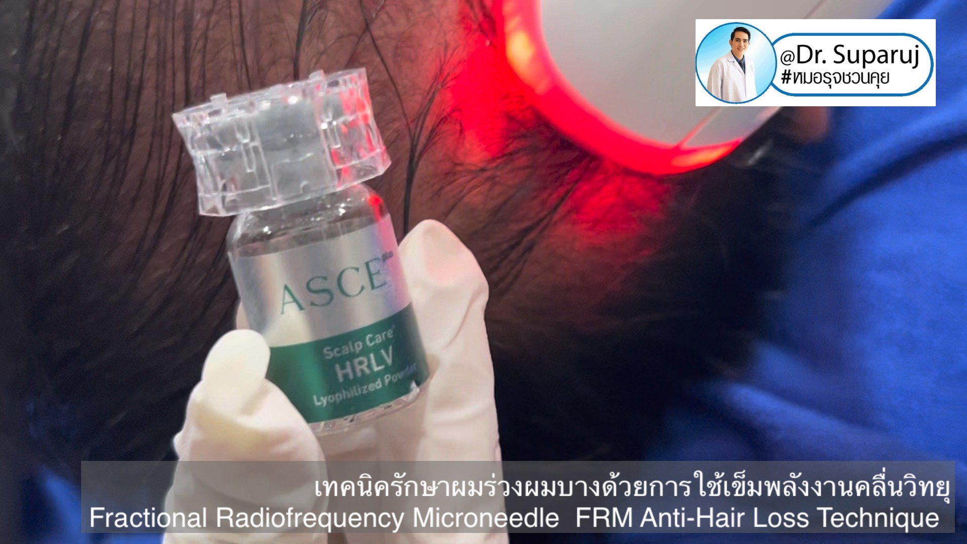 แนะนำเทคนิครักษาผมร่วงผมบาง: เทคนิครักษาผมร่วงผมบางด้วยการใช้เข็มพลังงานคลื่นวิทยุ Fractional Radiofrequency Microneedle FRM Anti-Hair Loss Technique แนะนำเทคนิครักษาผมร่วงผมบาง: เทคนิครักษาผมร่วงผมบางด้วยการใช้เข็มพลังงานคลื่นวิทยุ Fractional Radiofrequency Microneedle FRM Anti-Hair Loss Technique