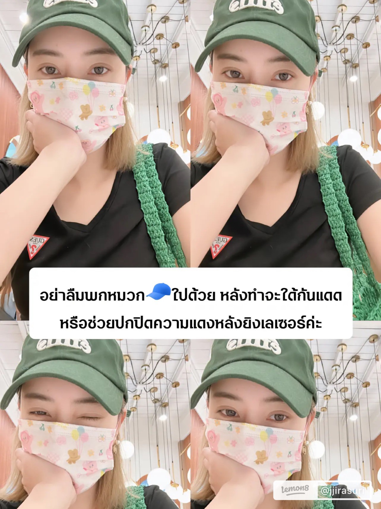 แนะนำเทคนิคดูแลรูขุมขนกว้าง: เทคนิคดูแลรูขุมขนกว้างด้วย Deep Carbon Peel Picosecond Laser (เทคนิคการใช้ Picosecond Laser พิโค่เลเซอร์ ร่วมกับผง carbon กระตุ้นการสร้างคอลลาเจนดูแลรูขุมขนกว้าง ) แนะนำเทคนิคดูแลรูขุมขนกว้าง: เทคนิคดูแลรูขุมขนกว้างด้วย Deep Carbon Peel Picosecond Laser (เทคนิคการใช้ Picosecond Laser พิโค่เลเซอร์ ร่วมกับผง carbon กระตุ้นการสร้างคอลลาเจนดูแลรูขุมขนกว้าง )