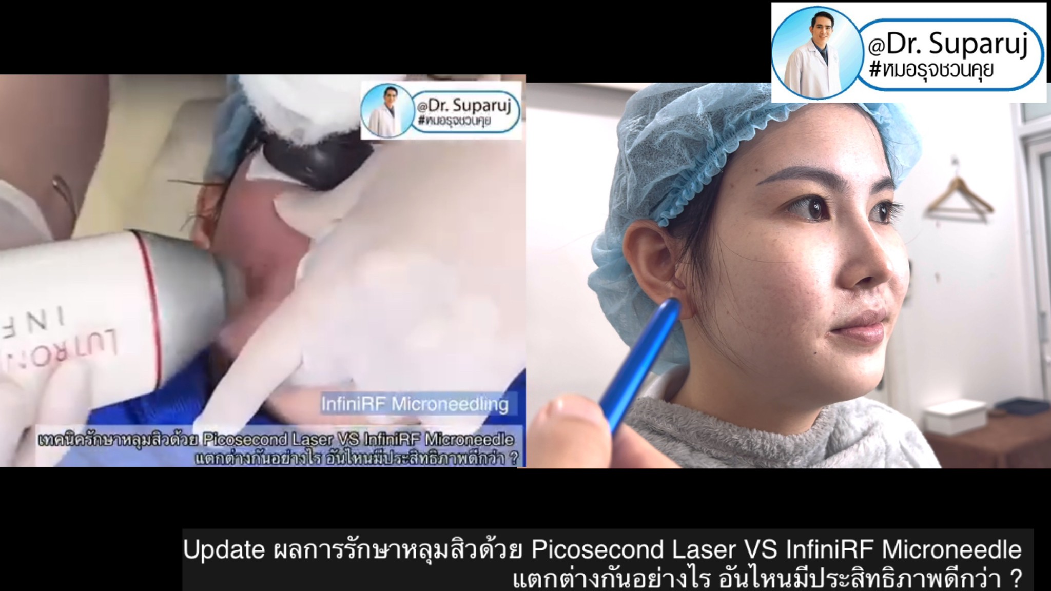 แนะนำเทคนิครักษาหลุมสิว: ดูแลหลุมสิวด้วยเข็มพลังงานคลื่นวิทยุ Infini RF Microneedle แนะนำเทคนิครักษาหลุมสิว: ดูแลหลุมสิวด้วยเข็มพลังงานคลื่นวิทยุ Infini RF Microneedle