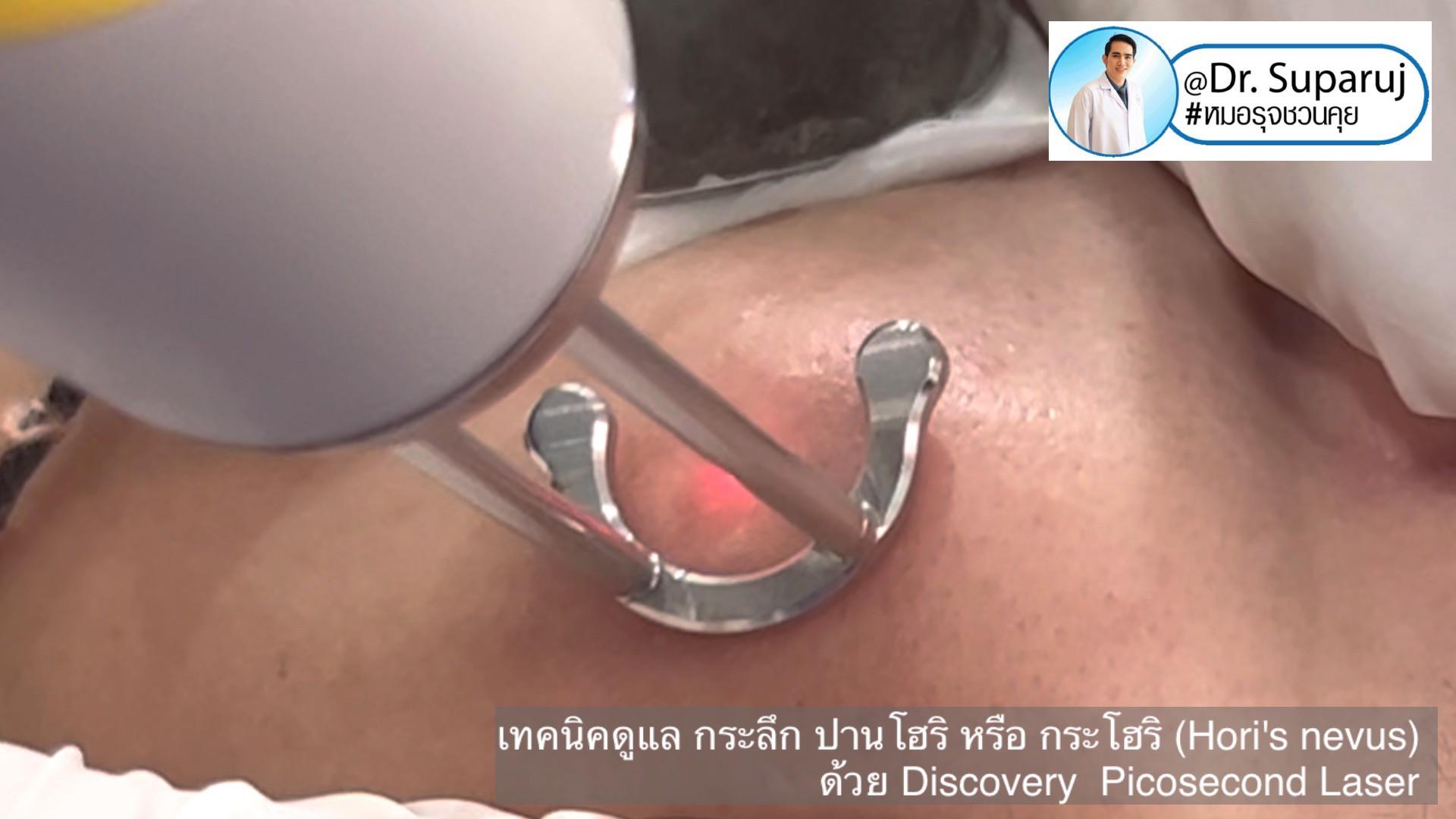 เทคนิครักษากระโฮริ กระลึก ปานโฮริ (Hori's nevus) ด้วยเลเซอร์ Discovery Picosecond Laser