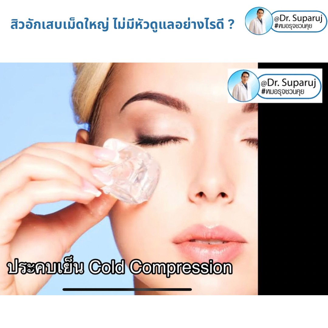 มีสิวอักเสบเม็ดใหญ่ ไม่มีหัว ขึ้น ดูแลอย่างไรดี ? มีสิวอักเสบเม็ดใหญ่ ไม่มีหัว ขึ้น ดูแลอย่างไรดี ?