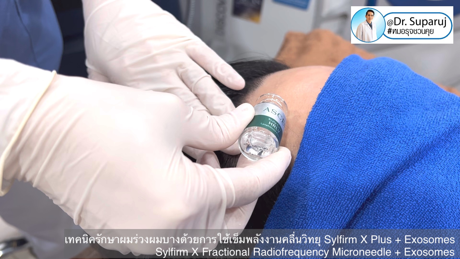 แนะนำ เทคนิครักษาผมร่วงผมบางด้วยการใช้เข็มพลังงานคลื่นวิทยุ Sylfirm X Plus + Exosomes (Sylfirm X Fractional Radiofrequency Microneedle + Exosomes) แนะนำ เทคนิครักษาผมร่วงผมบางด้วยการใช้เข็มพลังงานคลื่นวิทยุ Sylfirm X Plus + Exosomes (Sylfirm X Fractional Radiofrequency Microneedle + Exosomes)