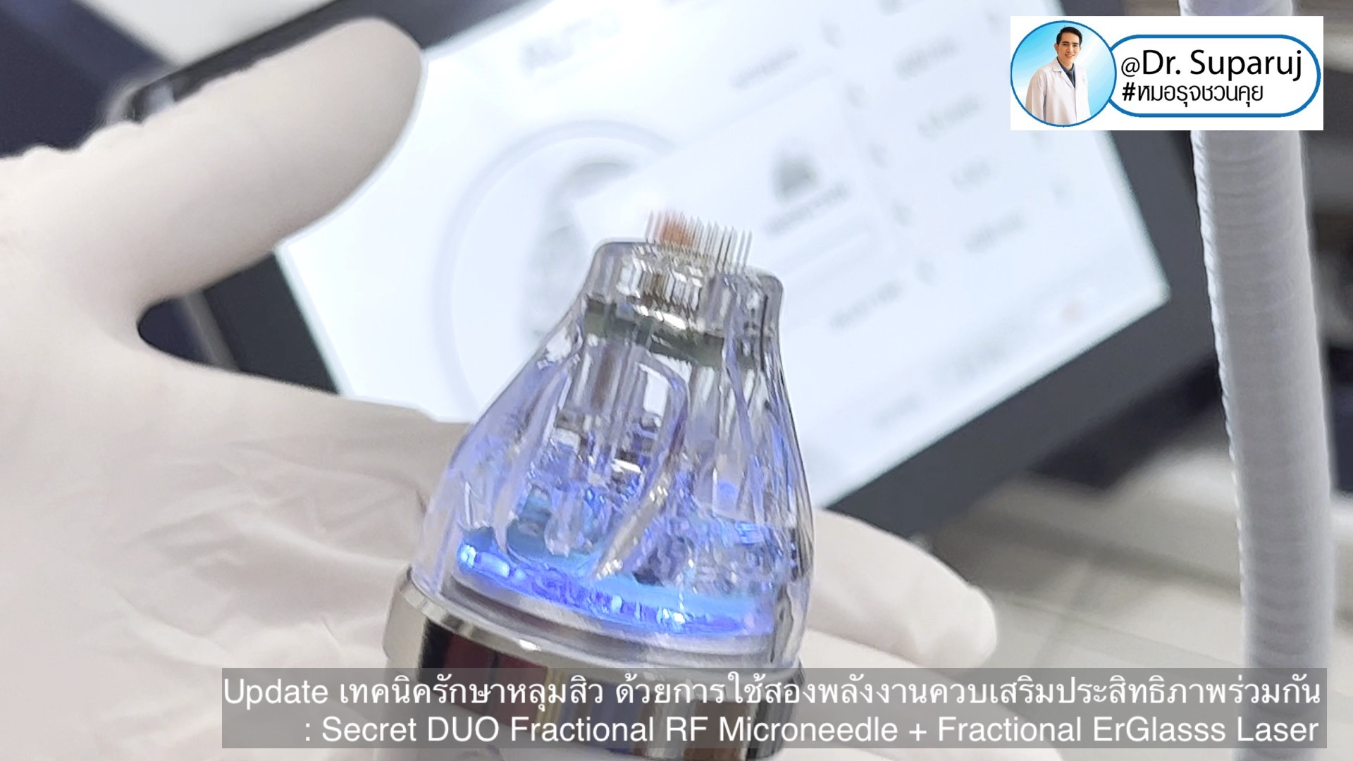 Update เทคนิครักษาหลุมสิว ด้วยการใช้สองพลังงานเสริมประสิทธิภาพร่วมกัน: Secret DUO Fractional RF Microneedle + Fractional ErGlasss Laser