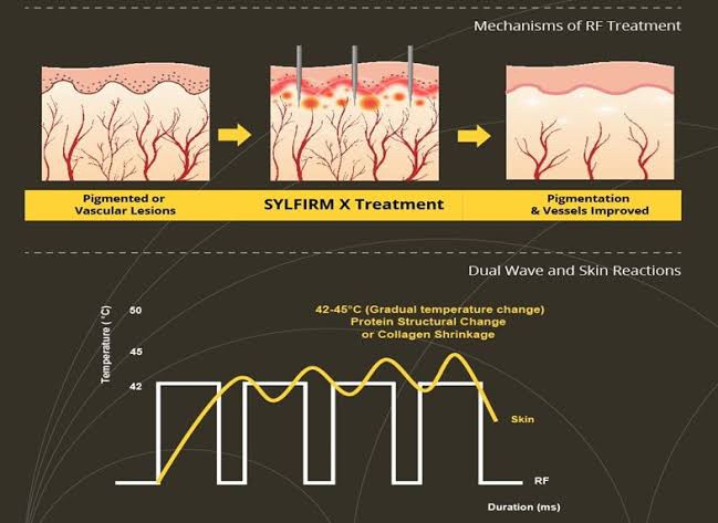 Update เทคนิคยกกระชับผิว หลุมสิว ดูแลปัญหาเม็ดสี ฝ้า+เส้นเลือด: SYLFIRM X นวัตกรรมคลื่นวิทยุแบบเข็ม (Fractional microneedle Radiofrequency) Update เทคนิคยกกระชับผิว หลุมสิว ดูแลปัญหาเม็ดสี ฝ้า+เส้นเลือด: SYLFIRM X นวัตกรรมคลื่นวิทยุแบบเข็ม (Fractional microneedle Radiofrequency)