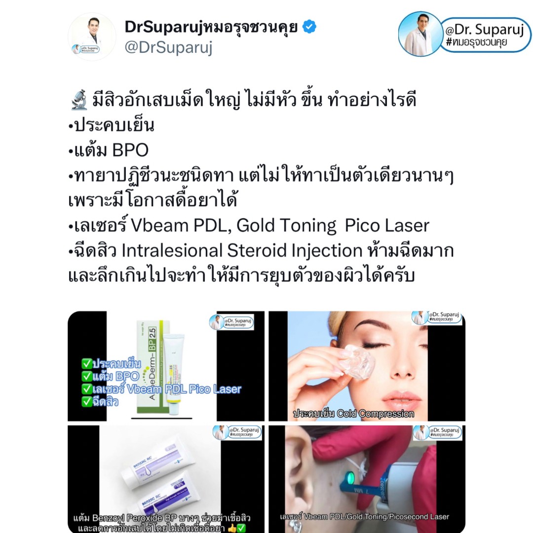 มีสิวอักเสบเม็ดใหญ่ ไม่มีหัว ขึ้น ดูแลอย่างไรดี ?