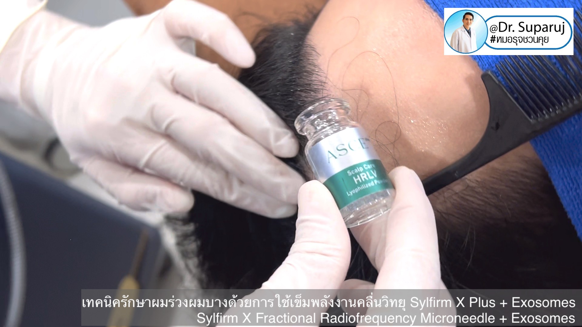 แนะนำเทคนิคดูแลผมร่วงผมบางด้วย Sylfirm X Fractional RF Microneedle + Exosomes for Hair Loss Treatment แนะนำเทคนิคดูแลผมร่วงผมบางด้วย Sylfirm X Fractional RF Microneedle + Exosomes for Hair Loss Treatment
