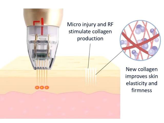 Update เทคนิคยกกระชับผิว หลุมสิว ดูแลปัญหาเม็ดสี ฝ้า+เส้นเลือด: SYLFIRM X นวัตกรรมคลื่นวิทยุแบบเข็ม (Fractional microneedle Radiofrequency)