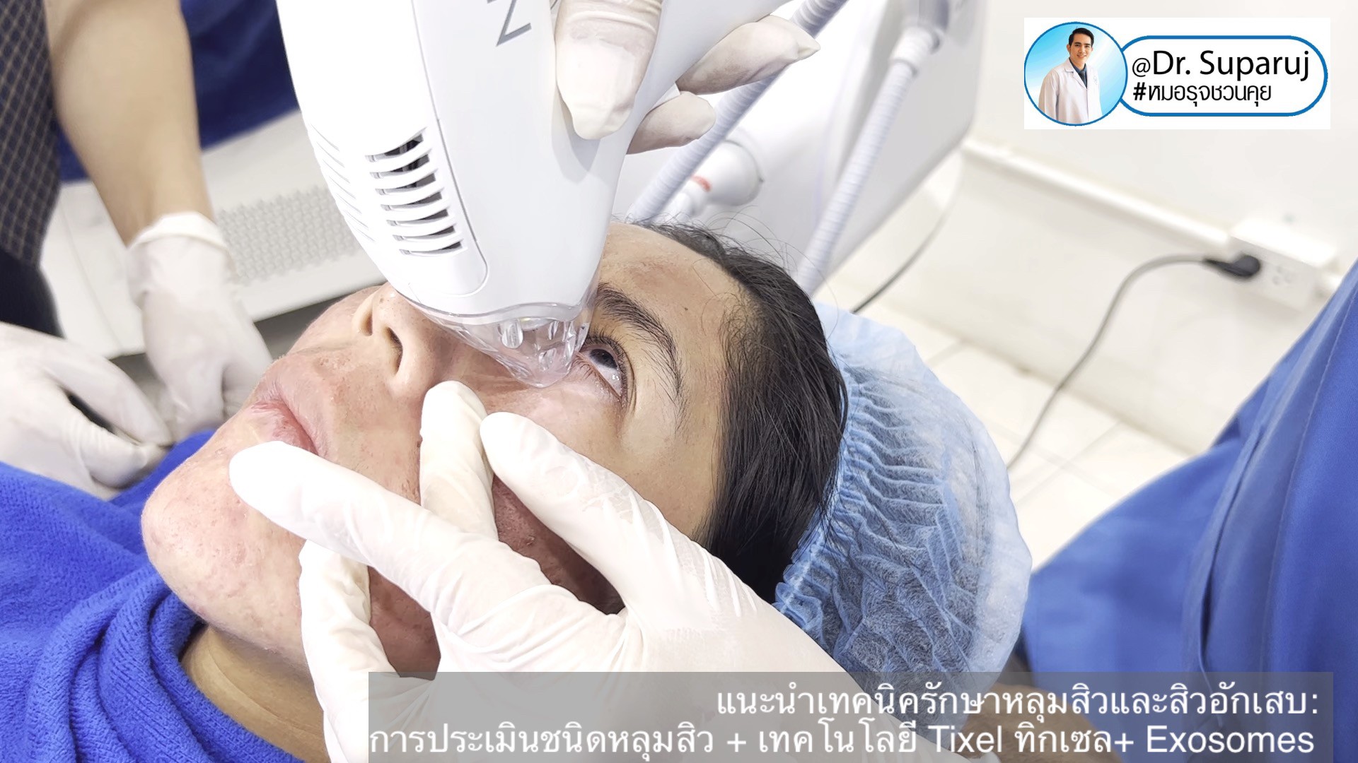 แนะนำเทคนิครักษาหลุมสิวและสิวอักเสบ: ประเมินชนิดความรุนแรงหลุมสิว + เทคโนโลยี Tixel ทิกเซล+ Exosomes แนะนำเทคนิครักษาหลุมสิวและสิวอักเสบ: ประเมินชนิดความรุนแรงหลุมสิว + เทคโนโลยี Tixel ทิกเซล+ Exosomes