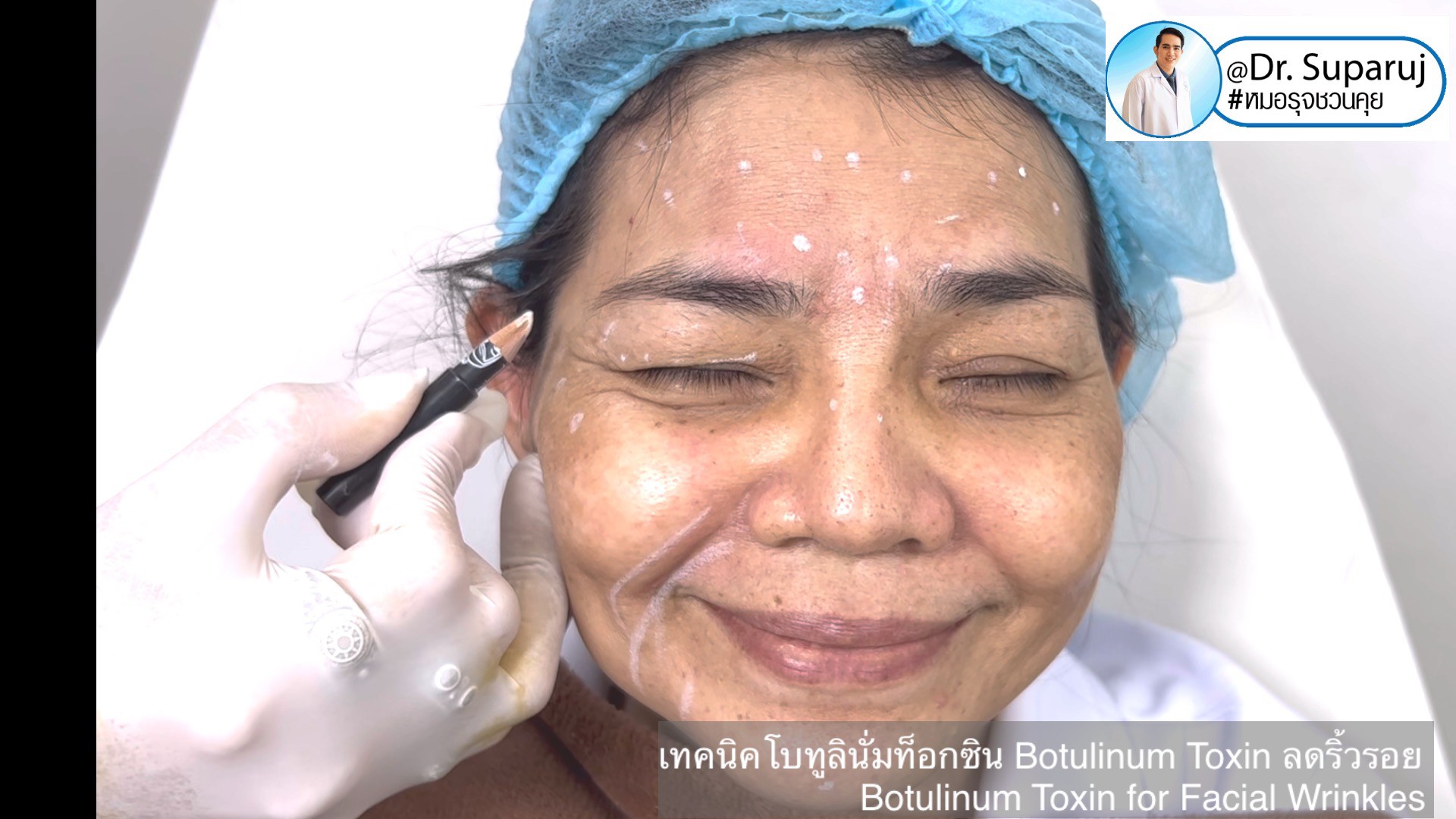 เทคนิคโบทูลินั่มท็อกซิน Botulinum Toxin ลดริ้วรอย Botulinum Toxin for Facial Wrinkles เทคนิคโบทูลินั่มท็อกซิน Botulinum Toxin ลดริ้วรอย Botulinum Toxin for Facial Wrinkles