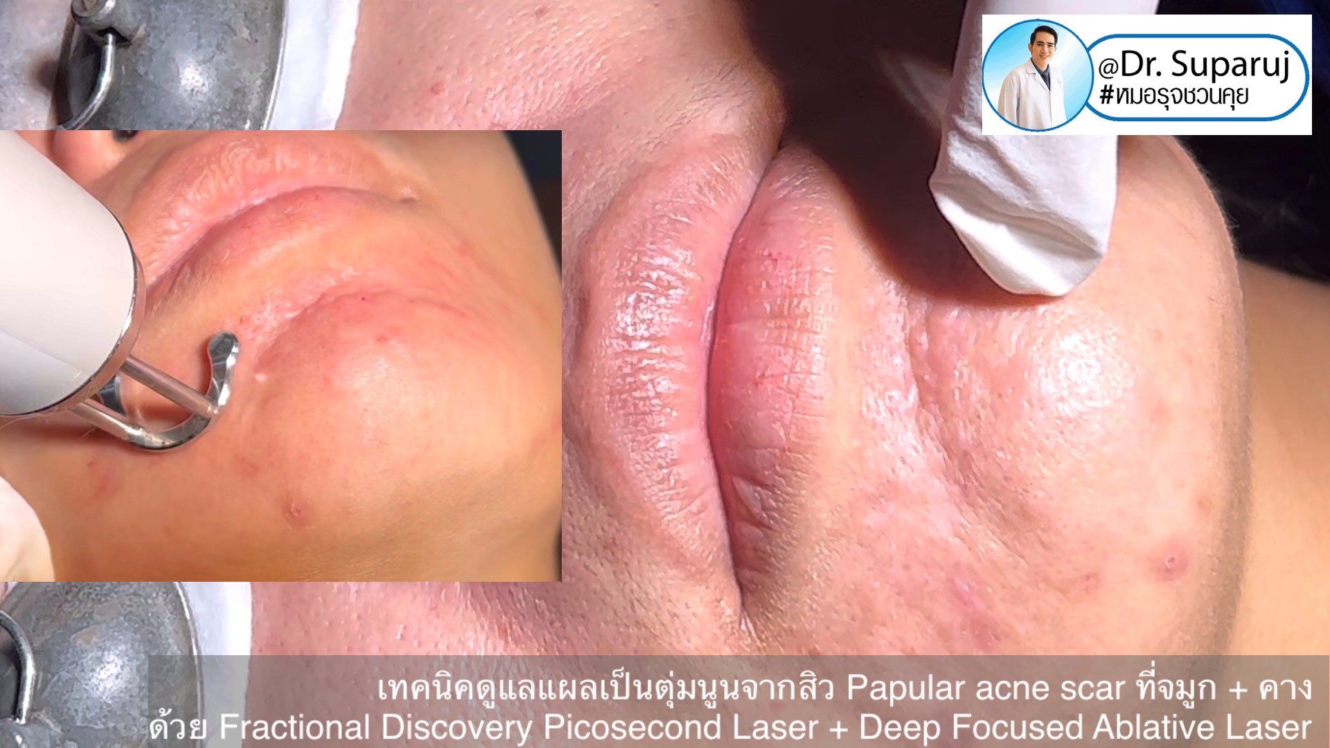 เทคนิคดูแลแผลเป็นตุ่มนูนจากสิว Papular acne scar ที่จมูก + คาง ด้วย Fractional Discovery Picosecond Laser + Deep Focused Ablative Laser เทคนิคดูแลแผลเป็นตุ่มนูนจากสิว Papular acne scar ที่จมูก + คาง ด้วย Fractional Discovery Picosecond Laser + Deep Focused Ablative Laser