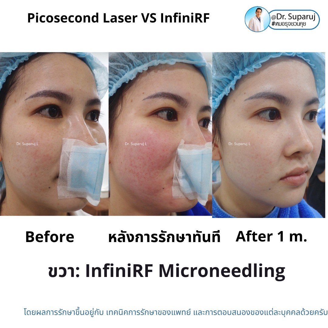 แนะนำเทคนิครักษาหลุมสิว: ดูแลหลุมสิวด้วยเข็มพลังงานคลื่นวิทยุ Infini RF Microneedle แนะนำเทคนิครักษาหลุมสิว: ดูแลหลุมสิวด้วยเข็มพลังงานคลื่นวิทยุ Infini RF Microneedle