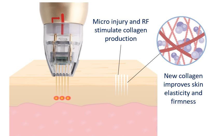 Update เทคนิคยกกระชับผิว หลุมสิว ดูแลปัญหาเม็ดสี ฝ้า+เส้นเลือด: SYLFIRM X นวัตกรรมคลื่นวิทยุแบบเข็ม (Fractional microneedle Radiofrequency) Update เทคนิคยกกระชับผิว หลุมสิว ดูแลปัญหาเม็ดสี ฝ้า+เส้นเลือด: SYLFIRM X นวัตกรรมคลื่นวิทยุแบบเข็ม (Fractional microneedle Radiofrequency)