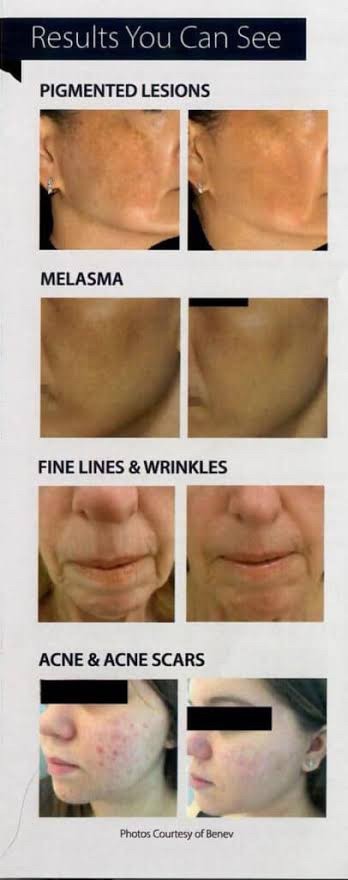 แนะนำเทคนิคดูแลฝ้า ด้วย SYLFIRM X Plus (SYLFIRMX Plus Fractional Radiofrequency Microneedle to Treat Melasma) แนะนำเทคนิคดูแลฝ้า ด้วย SYLFIRM X Plus (SYLFIRMX Plus Fractional Radiofrequency Microneedle to Treat Melasma)