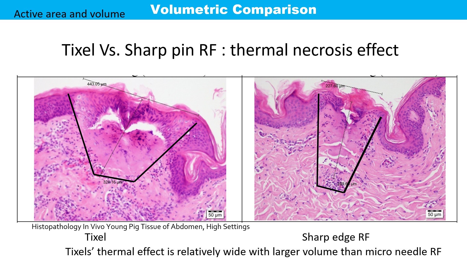 Update เทคนิครักษาหลุมสิว: Tixel ทิ๊กเซลล์ รักษาหลุมสิว ริ้วรอย แผลเป็น เพิ่มการดูดซึมยาด้วยเทคนิค TMA = Thermo-mechanical Abaltion Update เทคนิครักษาหลุมสิว: Tixel ทิ๊กเซลล์ รักษาหลุมสิว ริ้วรอย แผลเป็น เพิ่มการดูดซึมยาด้วยเทคนิค TMA = Thermo-mechanical Abaltion