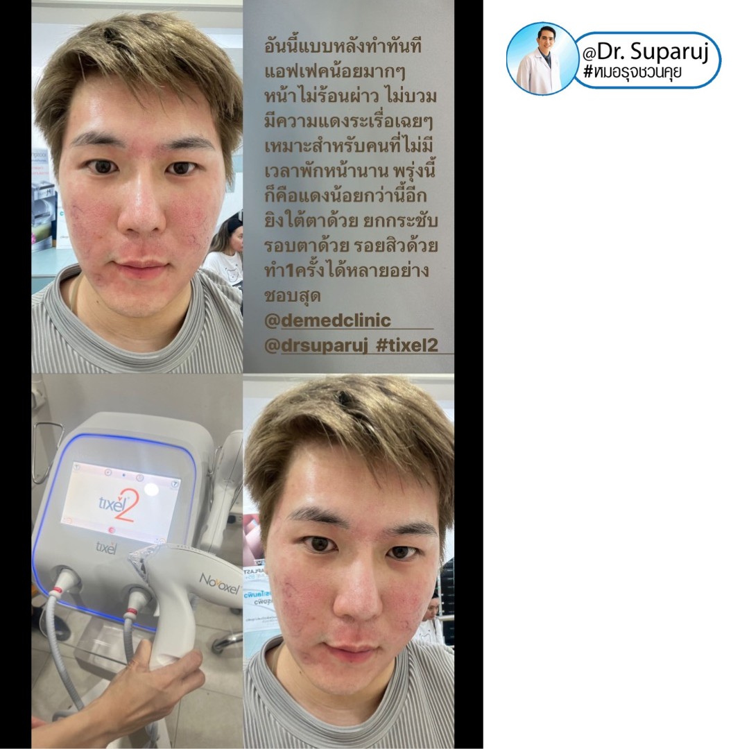 แนะนำเทคนิครักษาหลุมสิวและสิวอักเสบ: ประเมินชนิดความรุนแรงหลุมสิว + เทคโนโลยี Tixel ทิกเซล+ Exosomes แนะนำเทคนิครักษาหลุมสิวและสิวอักเสบ: ประเมินชนิดความรุนแรงหลุมสิว + เทคโนโลยี Tixel ทิกเซล+ Exosomes
