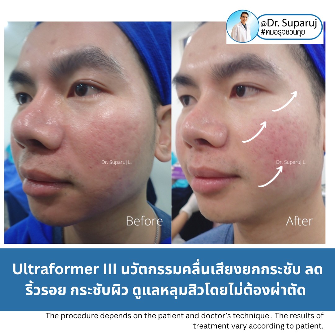 เทคโนโลยียกกระชับผิว MMFU : Micro &Macro Focused Ultrasound ของ Ultraformer III ทำงานอย่างไร ทำไมถึงดีกว่า HIFU ? เทคโนโลยียกกระชับผิว MMFU : Micro &Macro Focused Ultrasound ของ Ultraformer III ทำงานอย่างไร ทำไมถึงดีกว่า HIFU ?