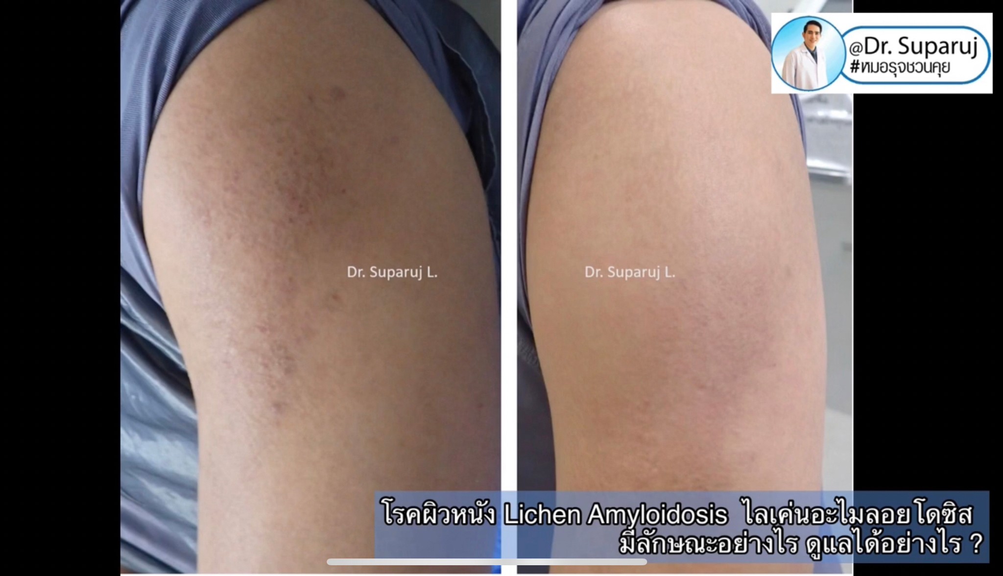 แนะนำการดูแลปัญหาโรคผิวหนัง: โรค Lichen amyloidosis ไลเค่น อะไมลอยโดซิส มีลักษณะอย่างไร ดูแลได้อย่างไร ? แนะนำการดูแลปัญหาโรคผิวหนัง: โรค Lichen amyloidosis ไลเค่น อะไมลอยโดซิส มีลักษณะอย่างไร ดูแลได้อย่างไร ?