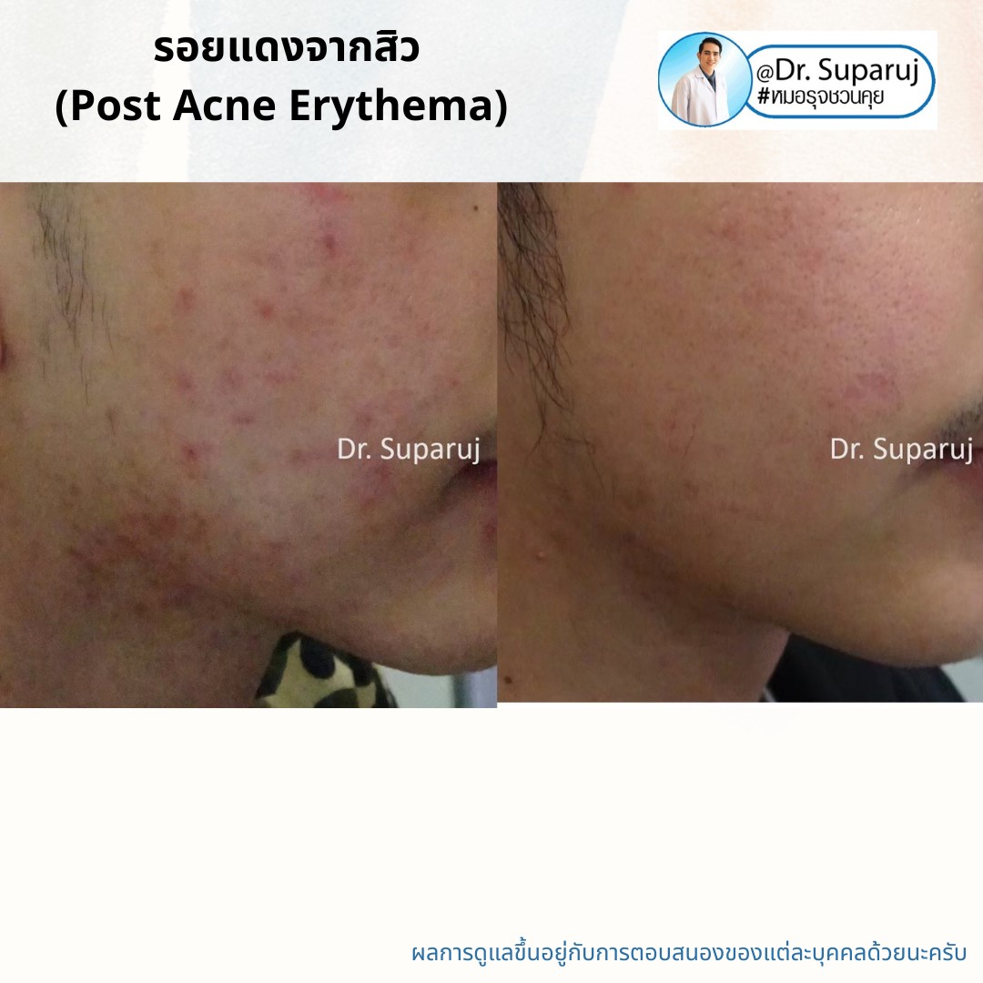 แชร์ประสบการณ์ Discovery Pico Laser พลีชีพความจริง แชร์ประสบการณ์ Discovery Pico Laser พลีชีพความจริง