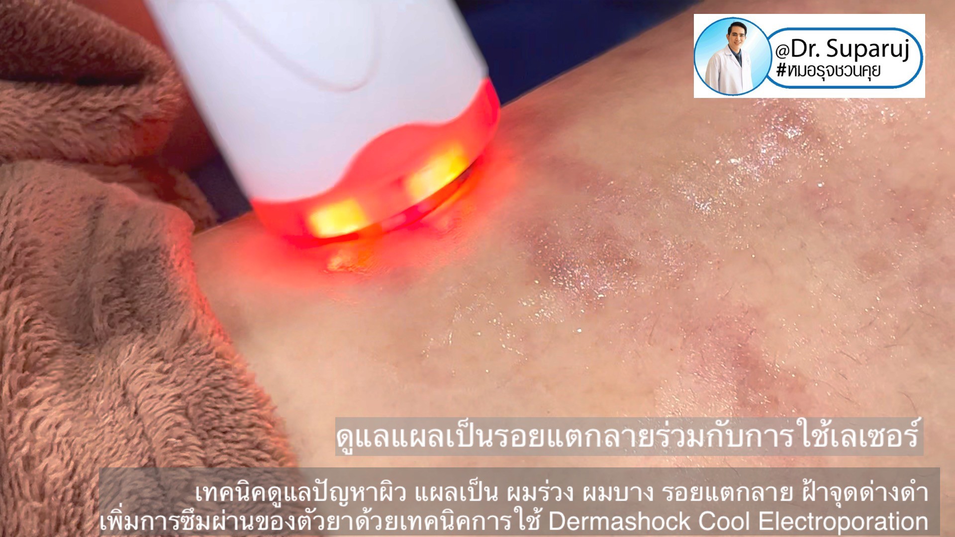 เทคนิคดูแลปัญหาผิว แผลเป็น ผมร่วง ผมบาง รอยแตกลาย ฝ้าจุดด่างดำ เพิ่มการซึมผ่านของตัวยาด้วยเทคนิคการใช้ Dermashock Cool Electroporation เทคนิคดูแลปัญหาผิว แผลเป็น ผมร่วง ผมบาง รอยแตกลาย ฝ้าจุดด่างดำ เพิ่มการซึมผ่านของตัวยาด้วยเทคนิคการใช้ Dermashock Cool Electroporation