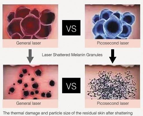 เทคนิครักษากระโฮริ กระลึก ปานโฮริ (Hori's nevus) ด้วยเลเซอร์ Discovery Picosecond Laser