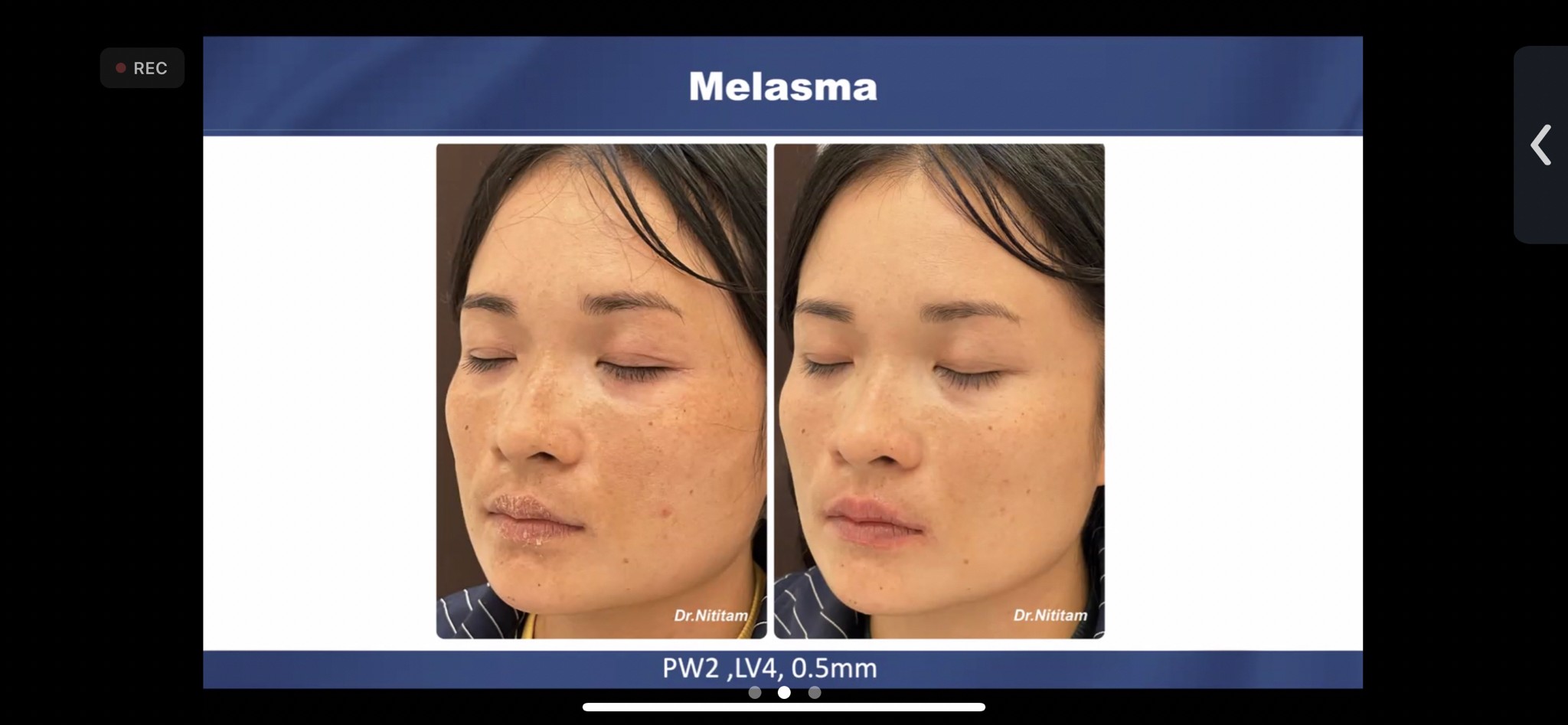 แนะนำเทคนิคดูแลฝ้า ด้วย SYLFIRM X Plus (SYLFIRMX Plus Fractional Radiofrequency Microneedle to Treat Melasma) แนะนำเทคนิคดูแลฝ้า ด้วย SYLFIRM X Plus (SYLFIRMX Plus Fractional Radiofrequency Microneedle to Treat Melasma)