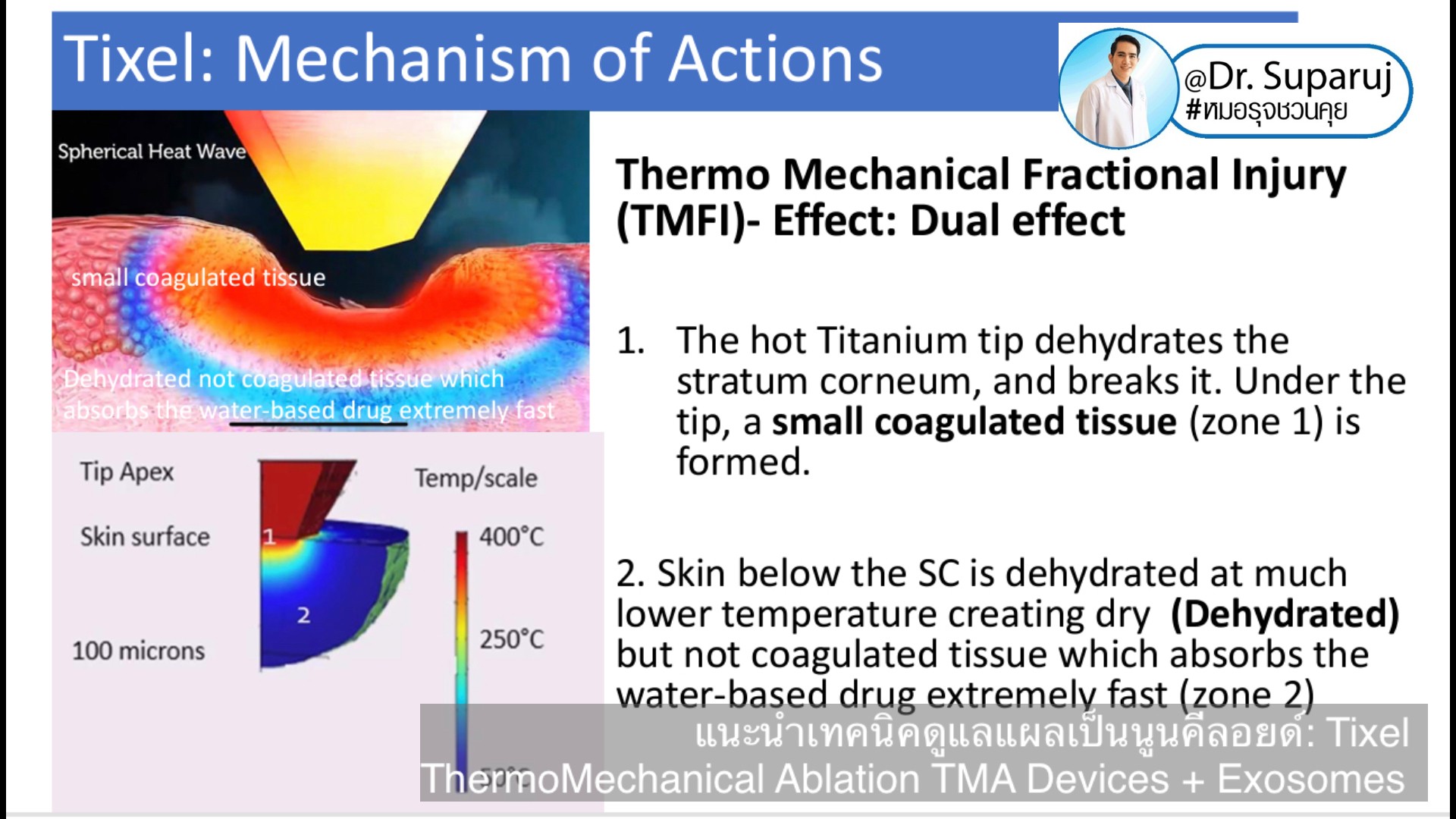 แนะนำเทคนิคดูแลแผลเป็นนูนคีลอยด์: รักษาแผลเป็นนูนด้วยทิกเซลล์ Tixel Fractional ThermoMechanical Ablation Devices + Exosomes แนะนำเทคนิคดูแลแผลเป็นนูนคีลอยด์: รักษาแผลเป็นนูนด้วยทิกเซลล์ Tixel Fractional ThermoMechanical Ablation Devices + Exosomes