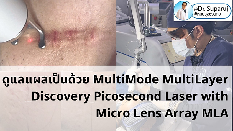 เทคนิคดูแลแผลเป็นด้วยเทคนิค MultiMode MultiLayer Discovery Picosecond Laser with Micro Lens Array MLA