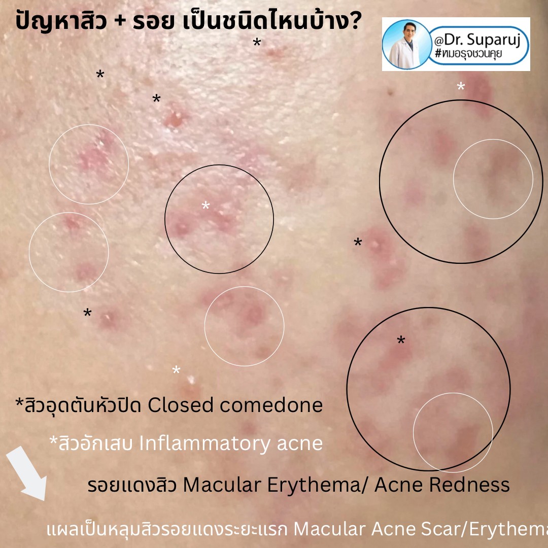 ปัญหาสิว + รอย เป็นชนิดไหนบ้าง? ปัญหาสิว + รอย เป็นชนิดไหนบ้าง?