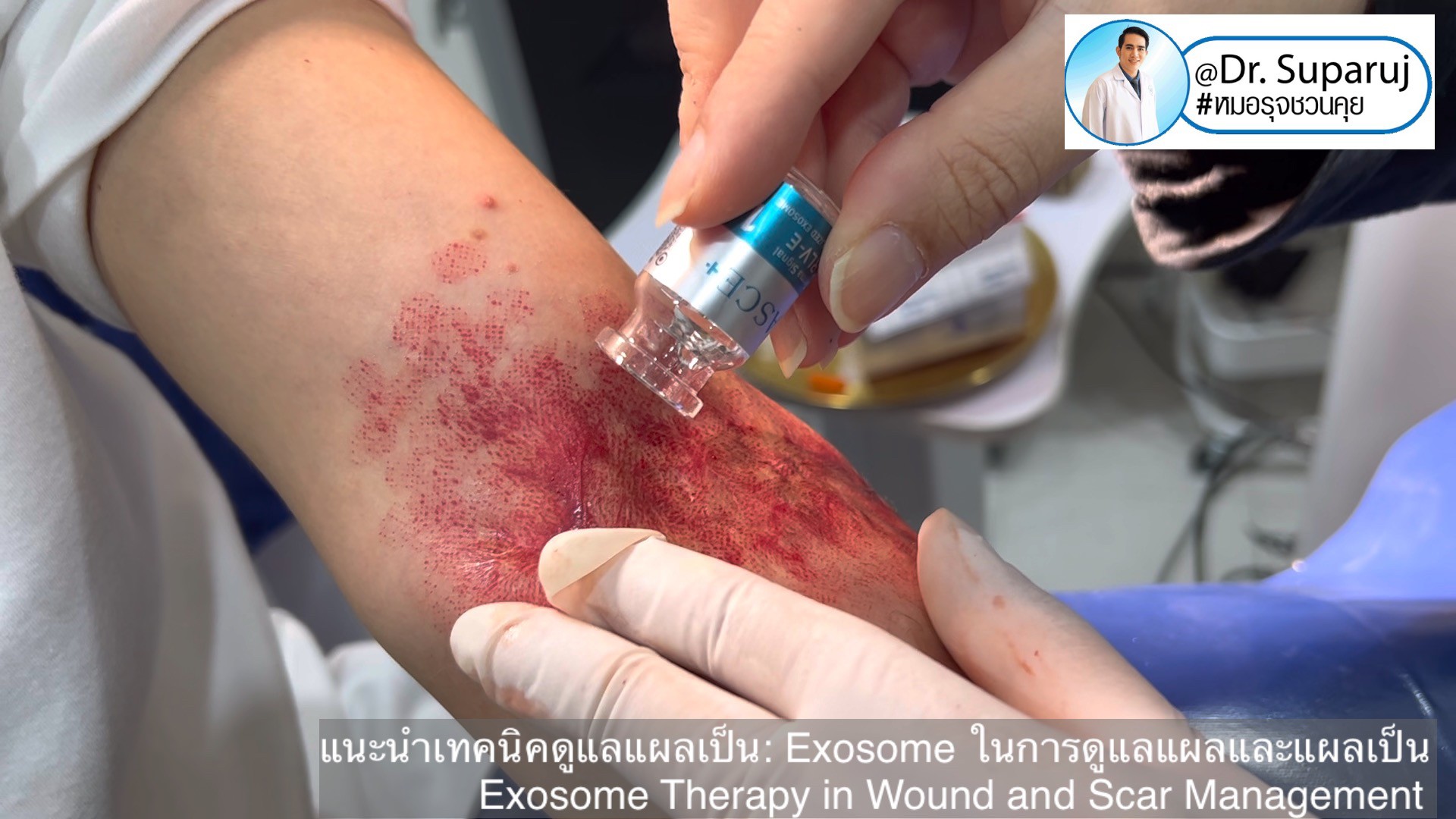 แนะนำเทคนิคดูแลแผลเป็น: Exosome ในการดูแลแผลและแผลเป็น Exosome Therapy in Wound and Scar Management แนะนำเทคนิคดูแลแผลเป็น: Exosome ในการดูแลแผลและแผลเป็น Exosome Therapy in Wound and Scar Management